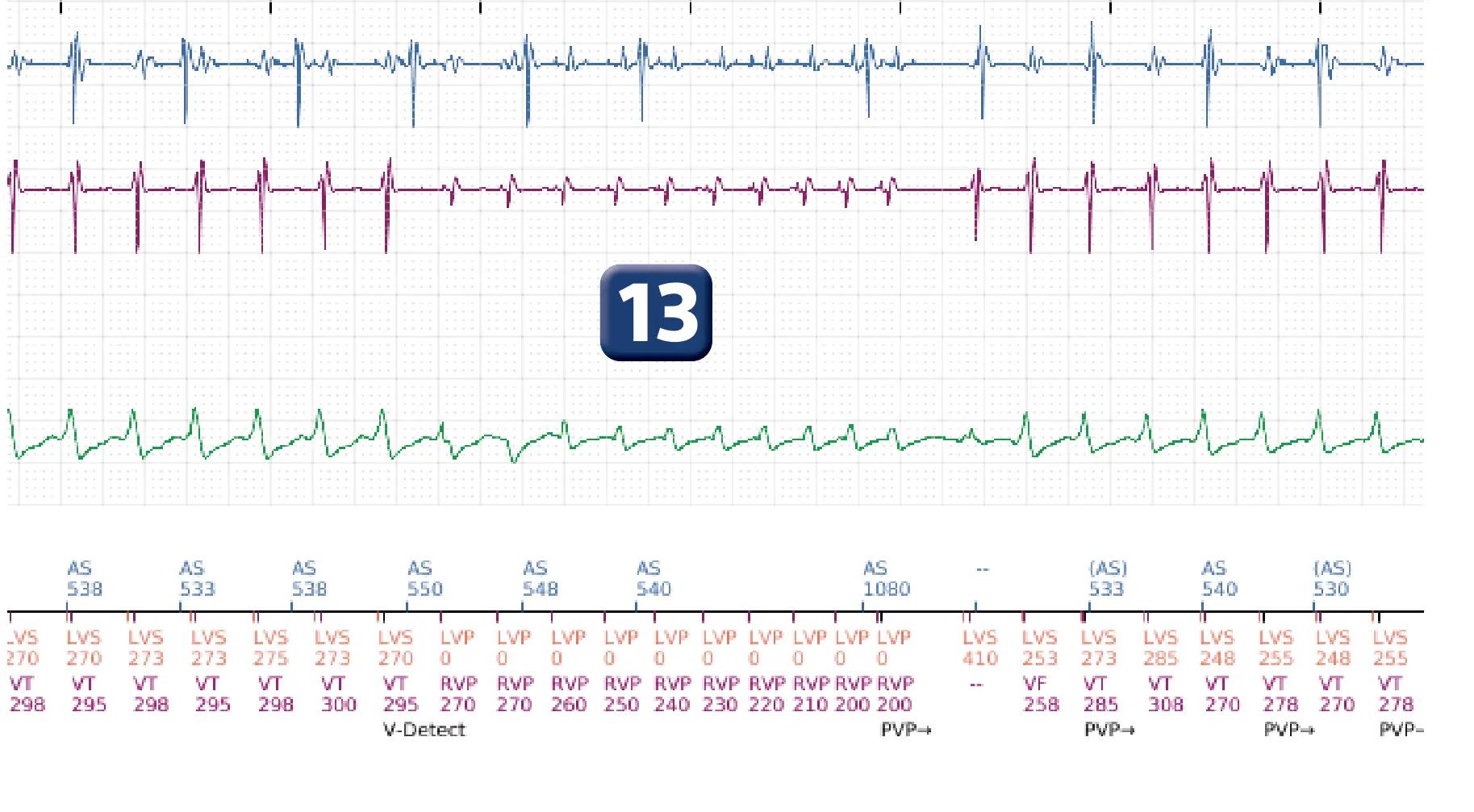Électrogramme Boston Scientific DAI, segment 10 sur 16 — Progression des thérapies en zone de TV