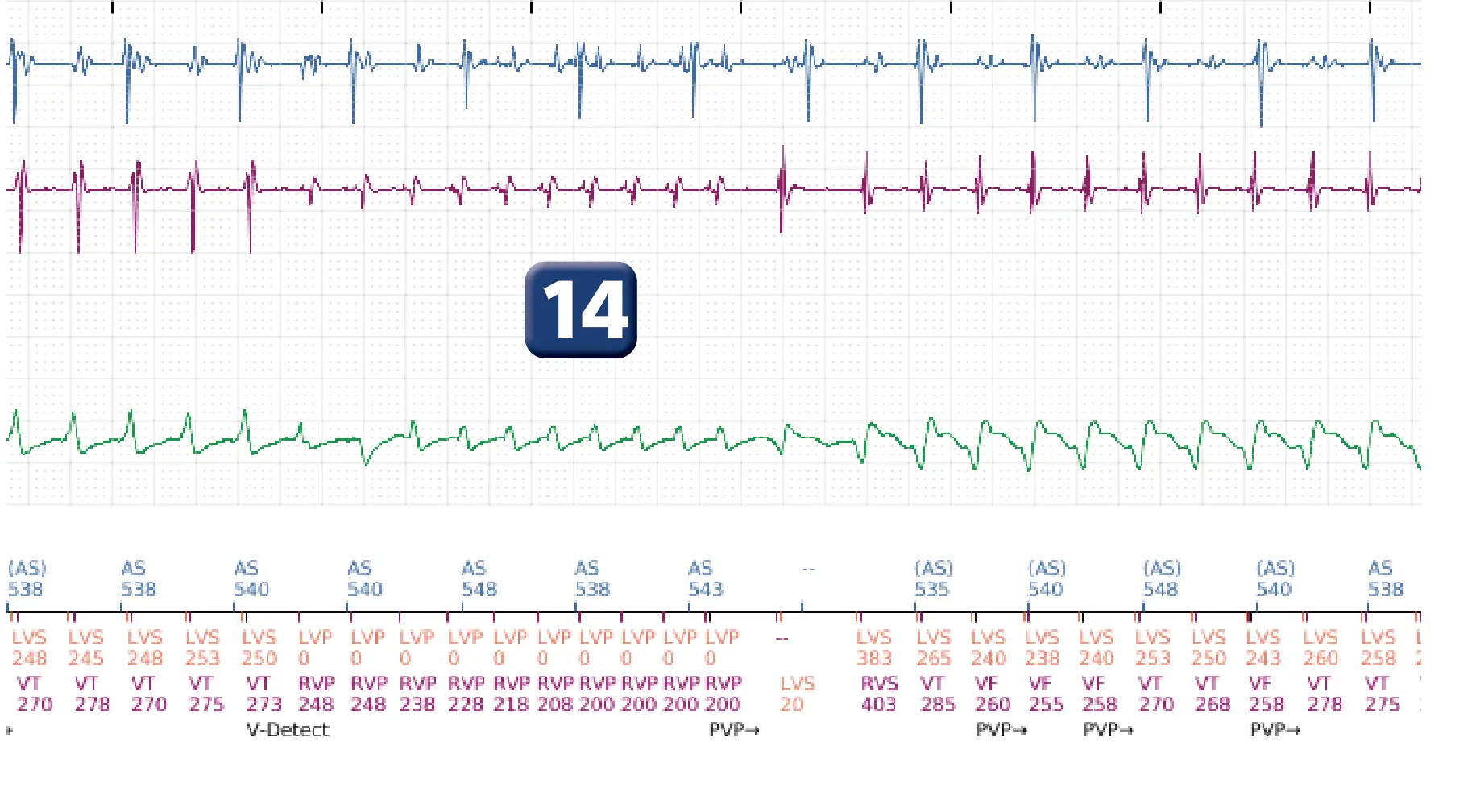 Électrogramme Boston Scientific DAI, segment 11 sur 16 — Progression des thérapies en zone de TV
