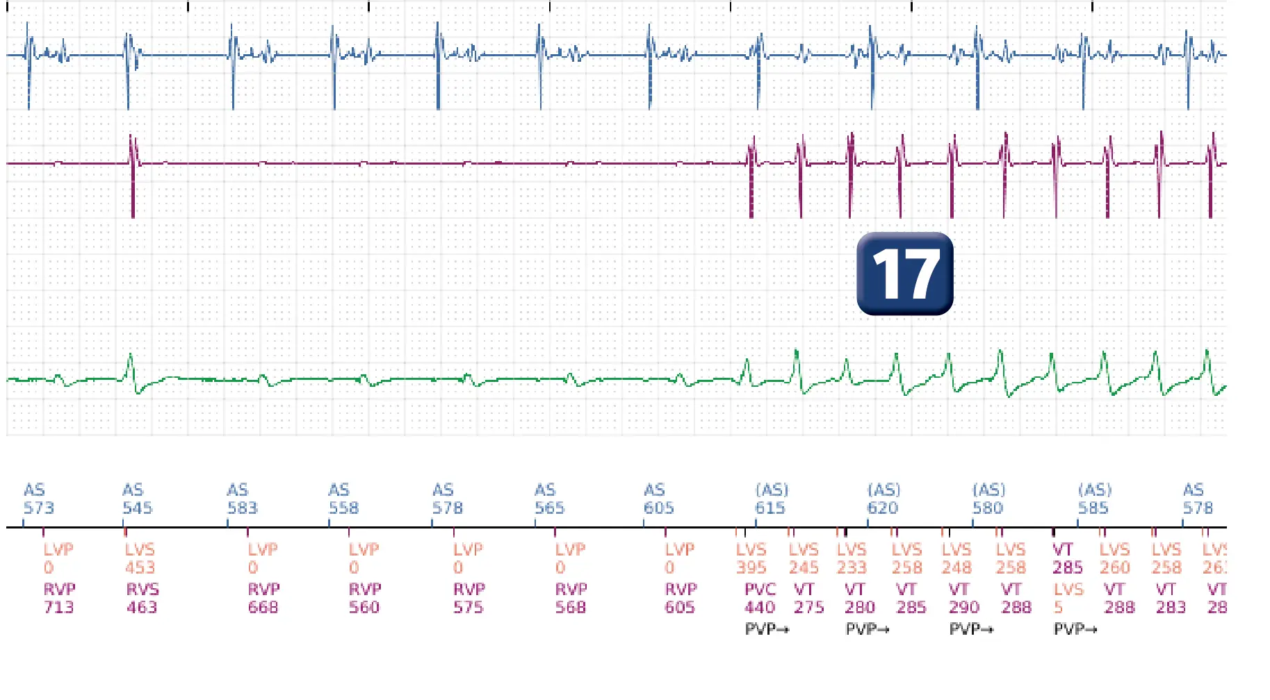 Électrogramme Boston Scientific DAI, segment 13 sur 16 — Progression des thérapies en zone de TV
