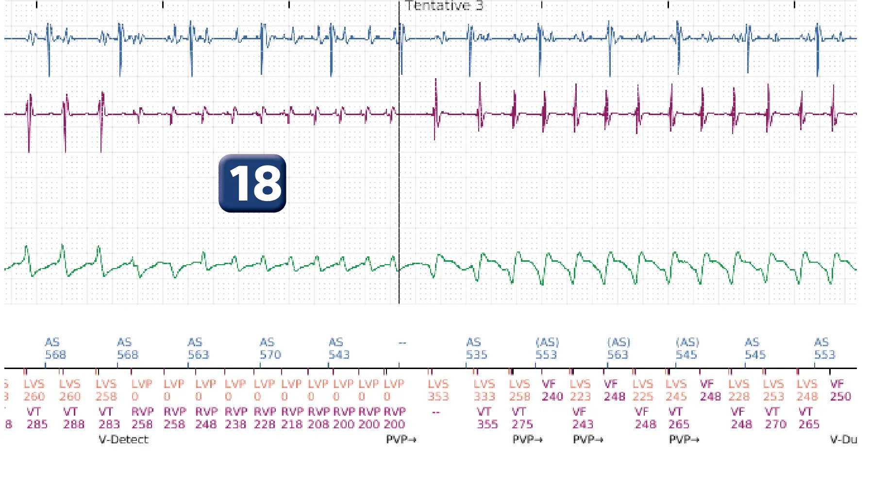 Électrogramme Boston Scientific DAI, segment 14 sur 16 — Progression des thérapies en zone de TV