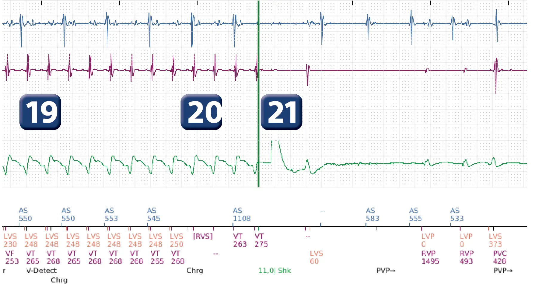 Électrogramme Boston Scientific DAI, segment 15 sur 16 — Progression des thérapies en zone de TV