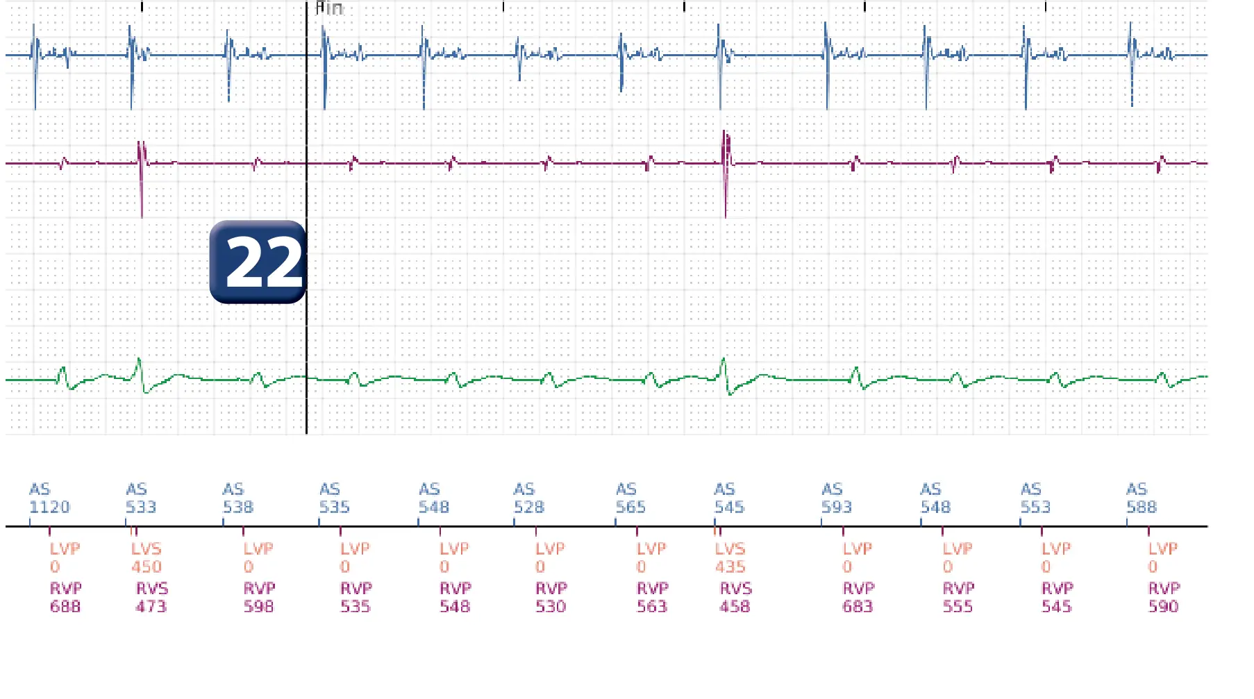 Électrogramme Boston Scientific DAI, segment 16 sur 16 — Progression des thérapies en zone de TV