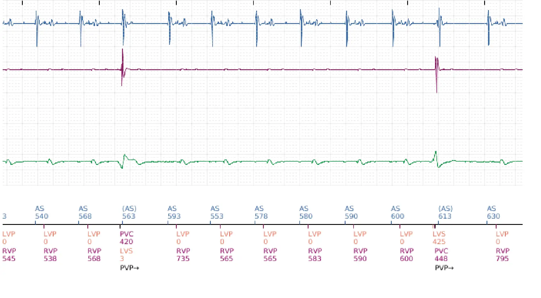 Électrogramme Boston Scientific DAI, segment 2 sur 16 — Progression des thérapies en zone de TV