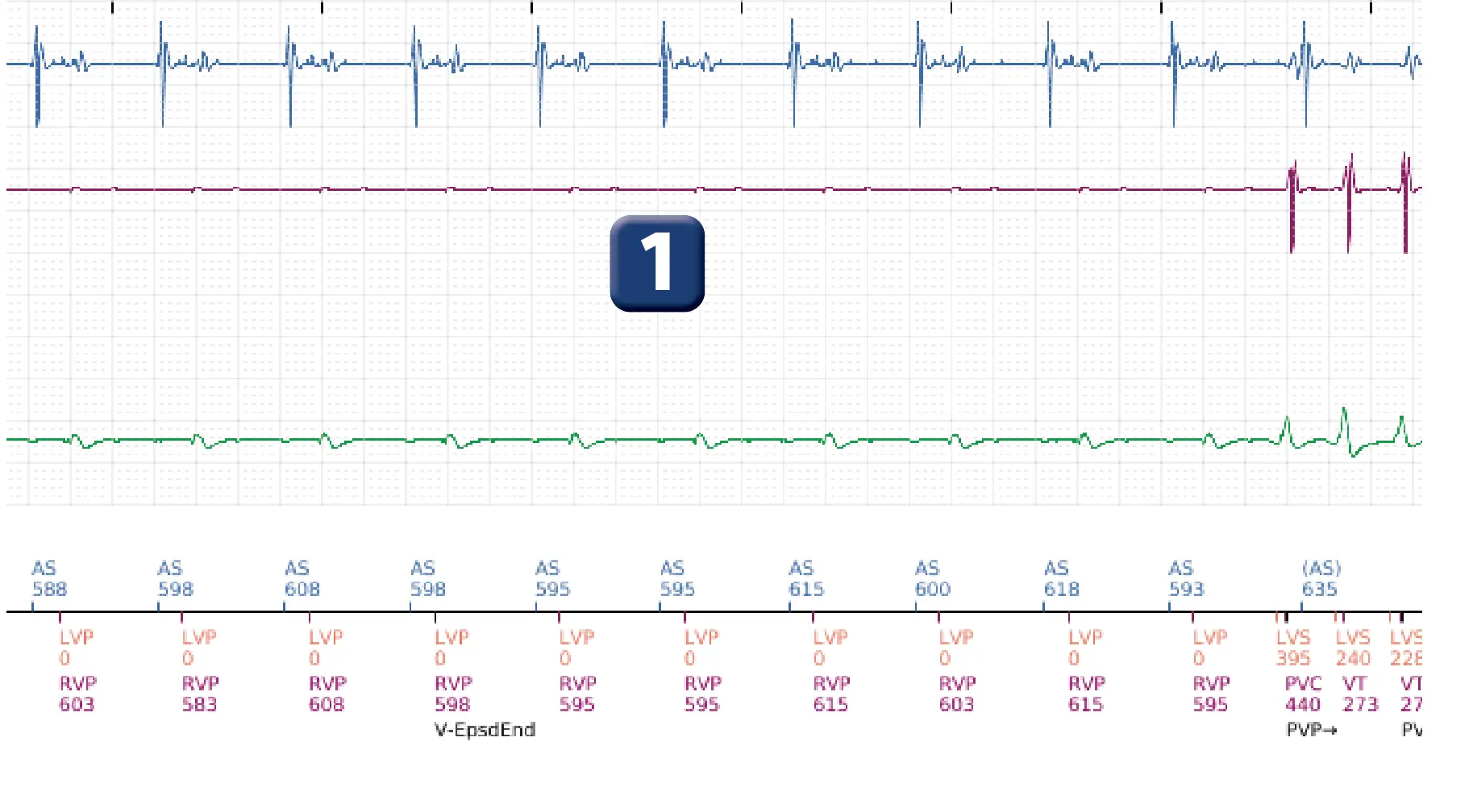 Électrogramme Boston Scientific DAI, segment 3 sur 16 — Progression des thérapies en zone de TV