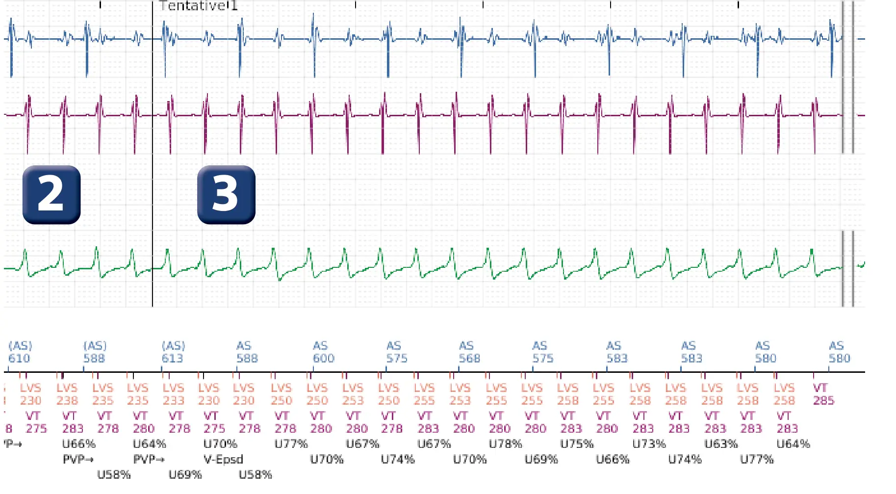 Électrogramme Boston Scientific DAI, segment 4 sur 16 — Progression des thérapies en zone de TV