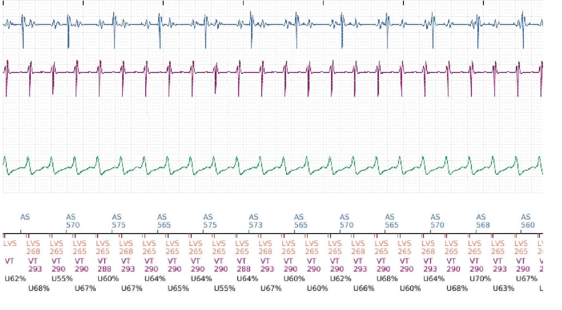 Électrogramme Boston Scientific DAI, segment 5 sur 16 — Progression des thérapies en zone de TV