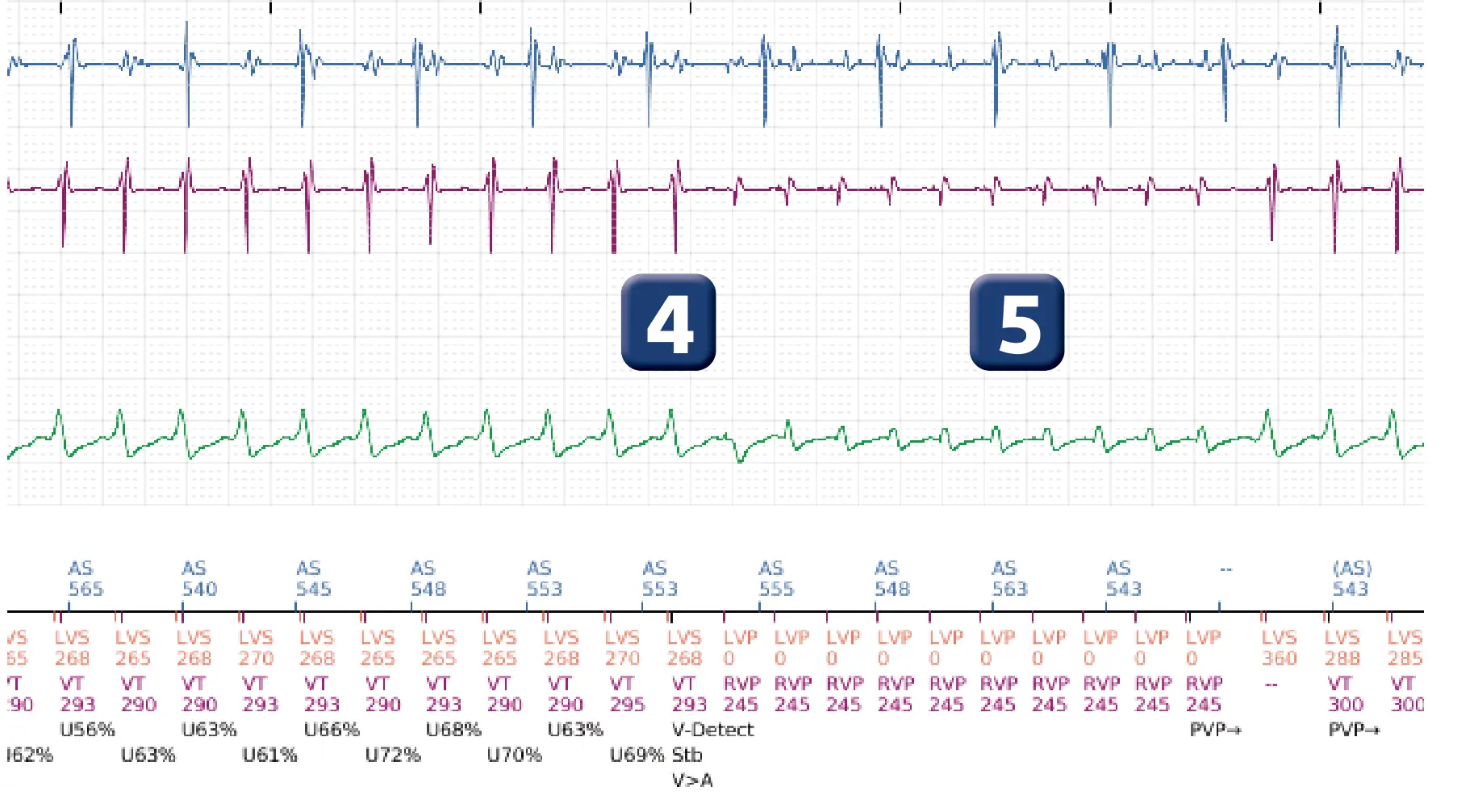 Électrogramme Boston Scientific DAI, segment 6 sur 16 — Progression des thérapies en zone de TV
