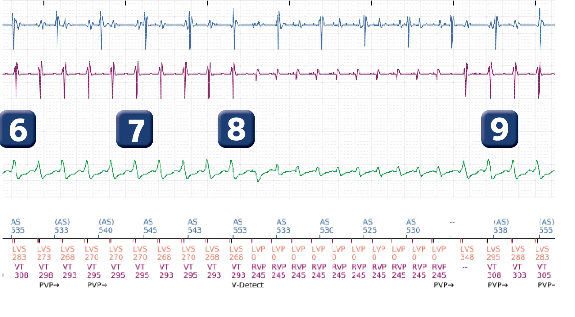 Électrogramme Boston Scientific DAI, segment 7 sur 16 — Progression des thérapies en zone de TV