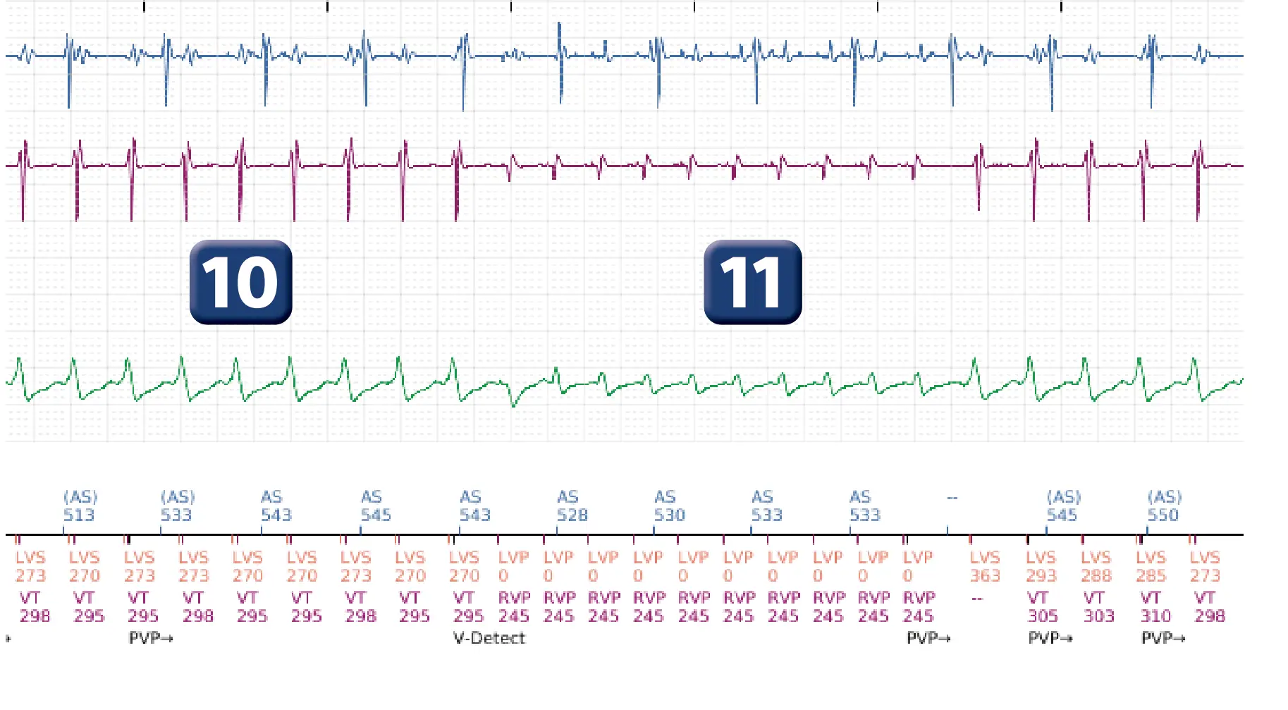 Électrogramme Boston Scientific DAI, segment 8 sur 16 — Progression des thérapies en zone de TV