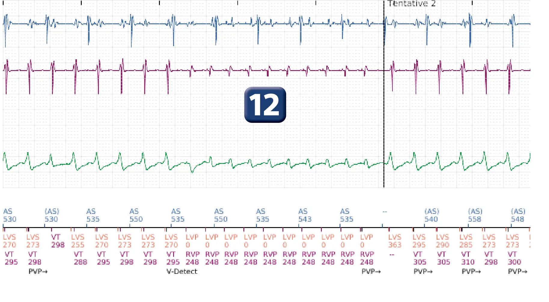 Électrogramme Boston Scientific DAI, segment 9 sur 16 — Progression des thérapies en zone de TV