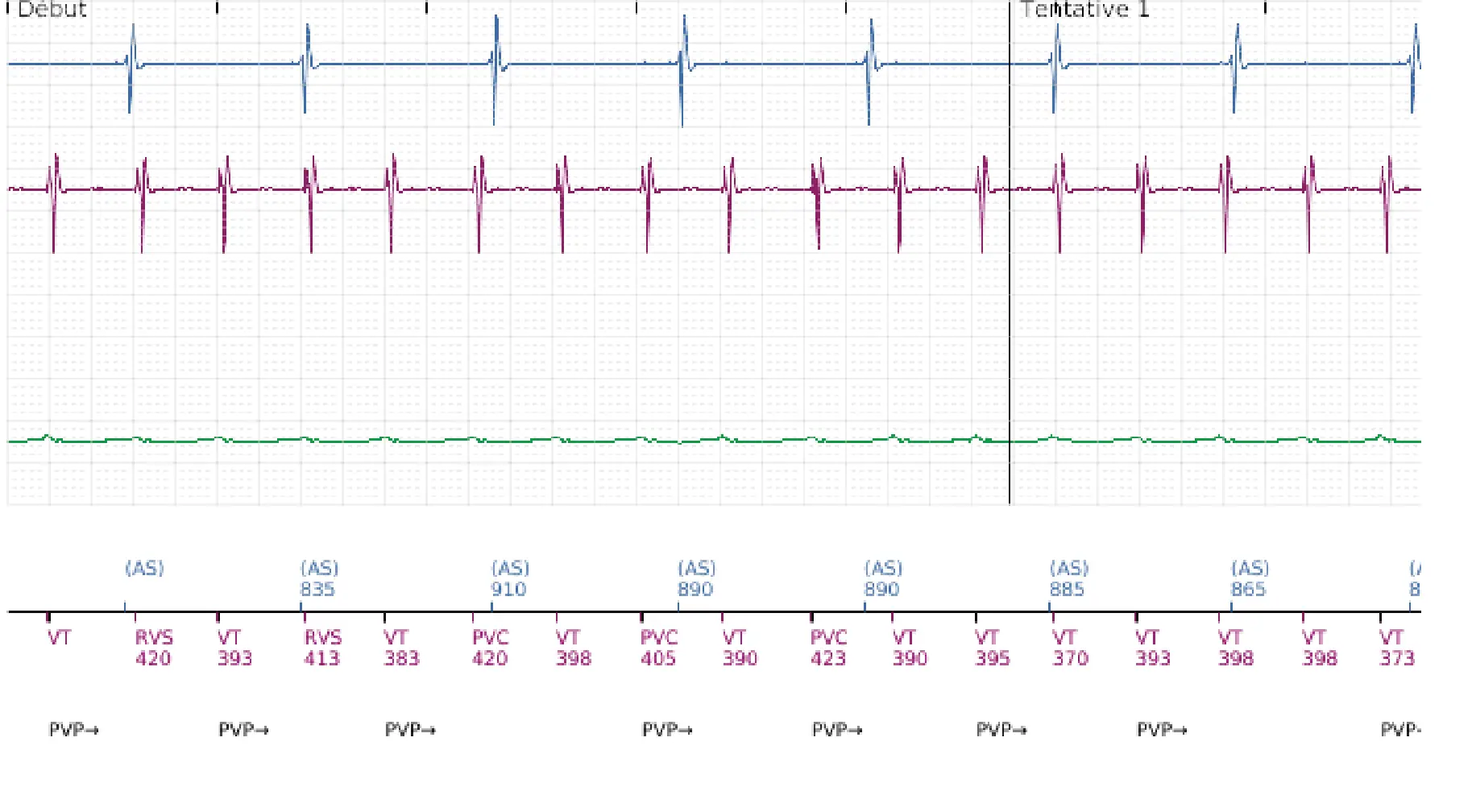 Électrogramme Boston Scientific DAI, segment 1 sur 16 — Choc à faible amplitude et accélération de l’arythmie