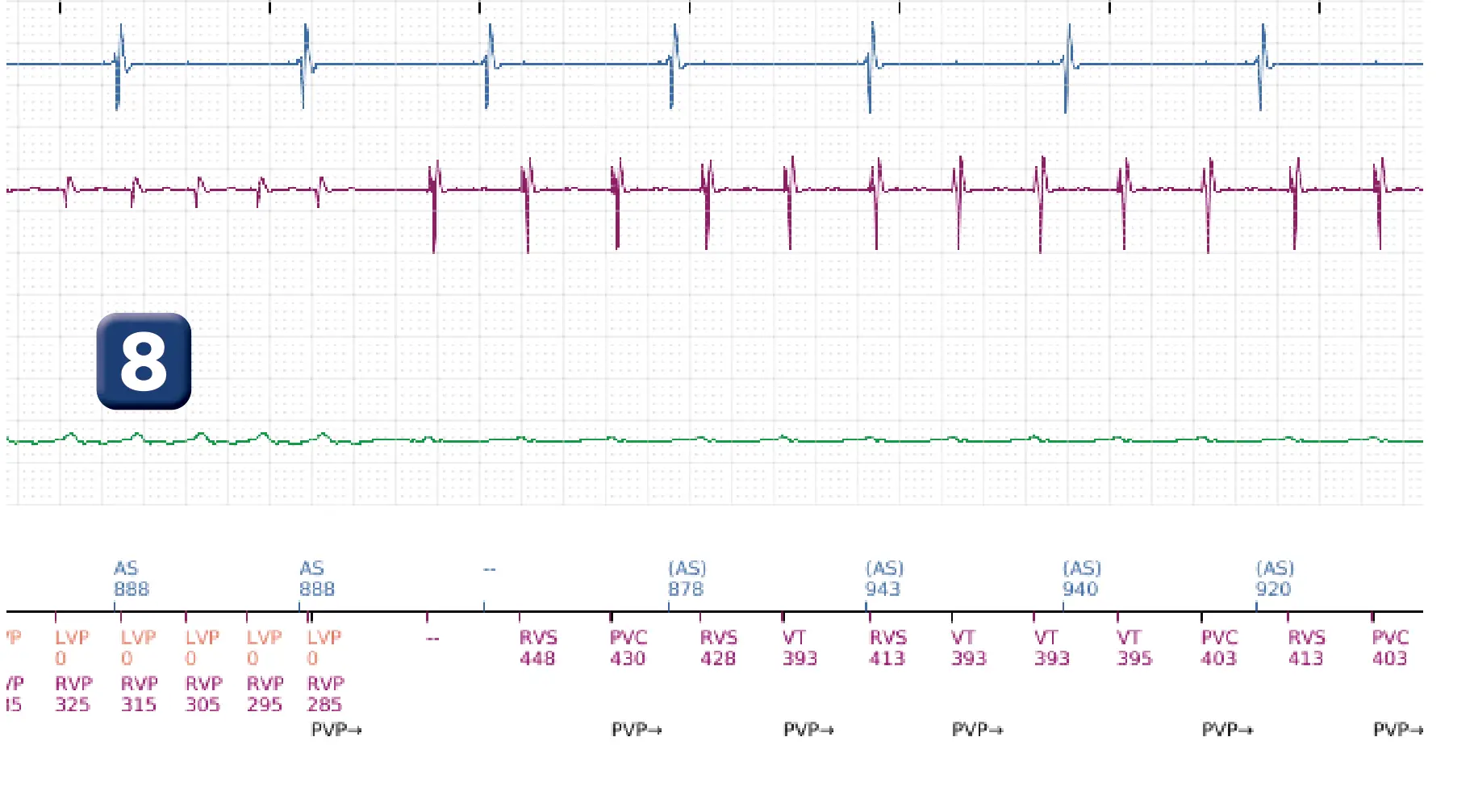 Électrogramme Boston Scientific DAI, segment 10 sur 16 — Choc à faible amplitude et accélération de l’arythmie