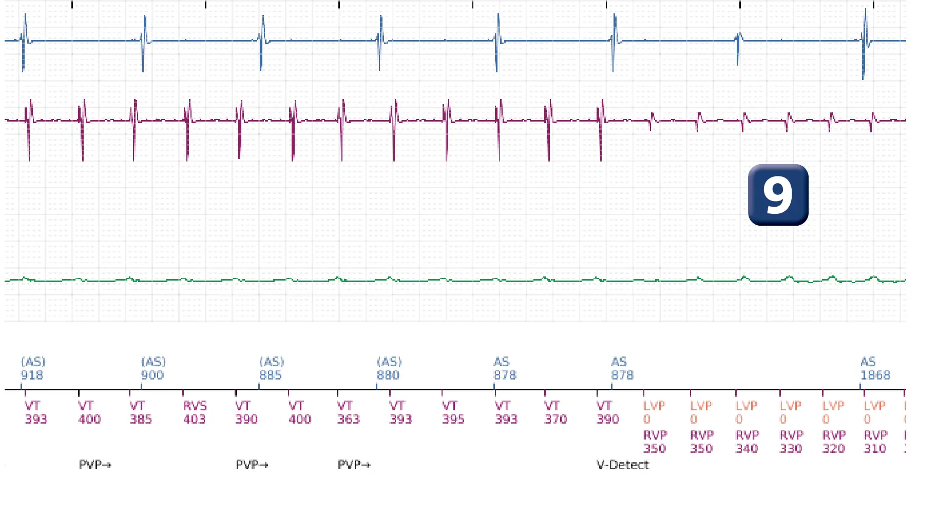 Électrogramme Boston Scientific DAI, segment 11 sur 16 — Choc à faible amplitude et accélération de l’arythmie