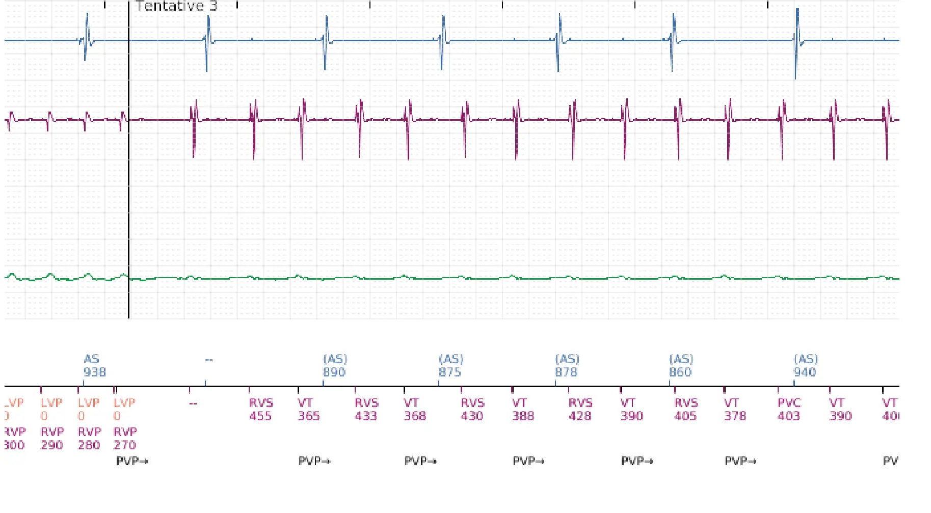 Électrogramme Boston Scientific DAI, segment 12 sur 16 — Choc à faible amplitude et accélération de l’arythmie