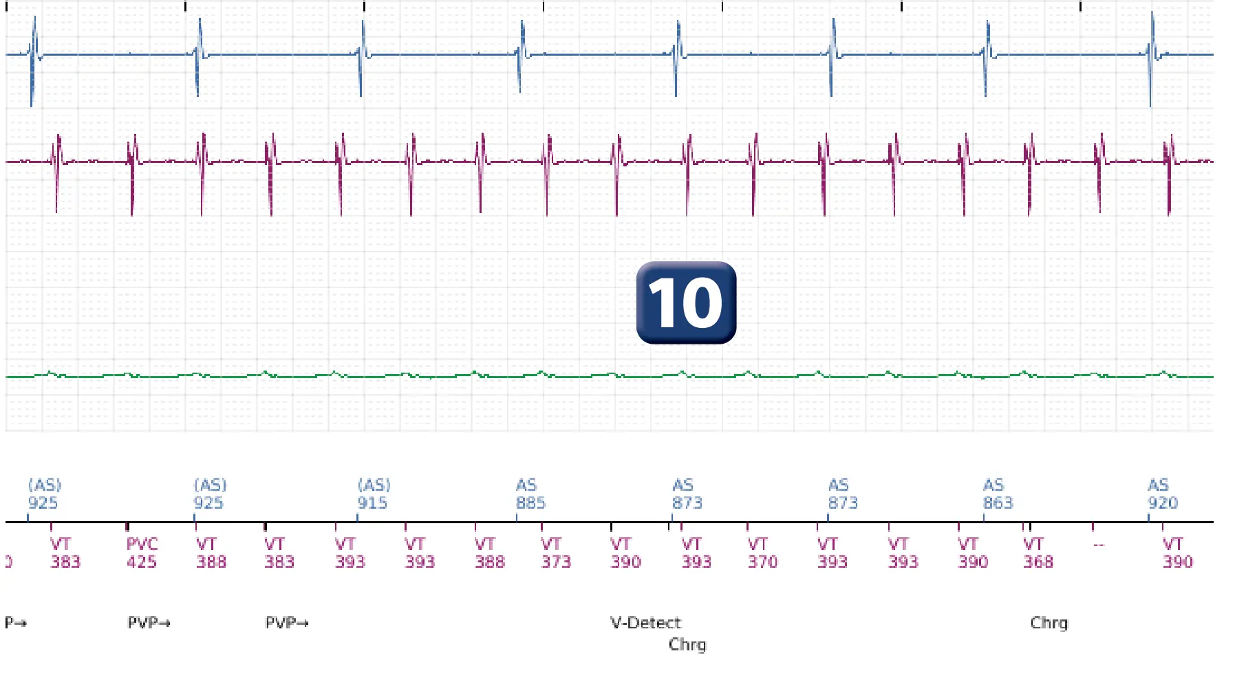 Électrogramme Boston Scientific DAI, segment 13 sur 16 — Choc à faible amplitude et accélération de l’arythmie