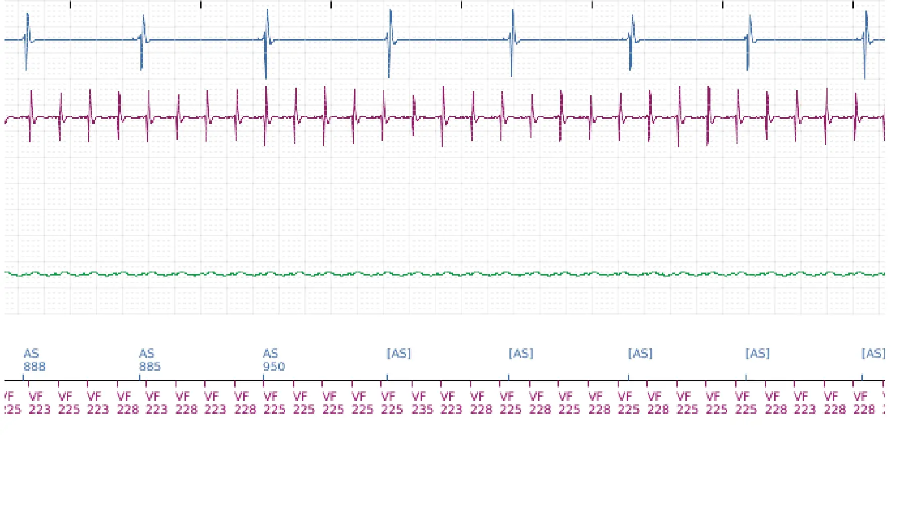 Électrogramme Boston Scientific DAI, segment 15 sur 16 — Choc à faible amplitude et accélération de l’arythmie
