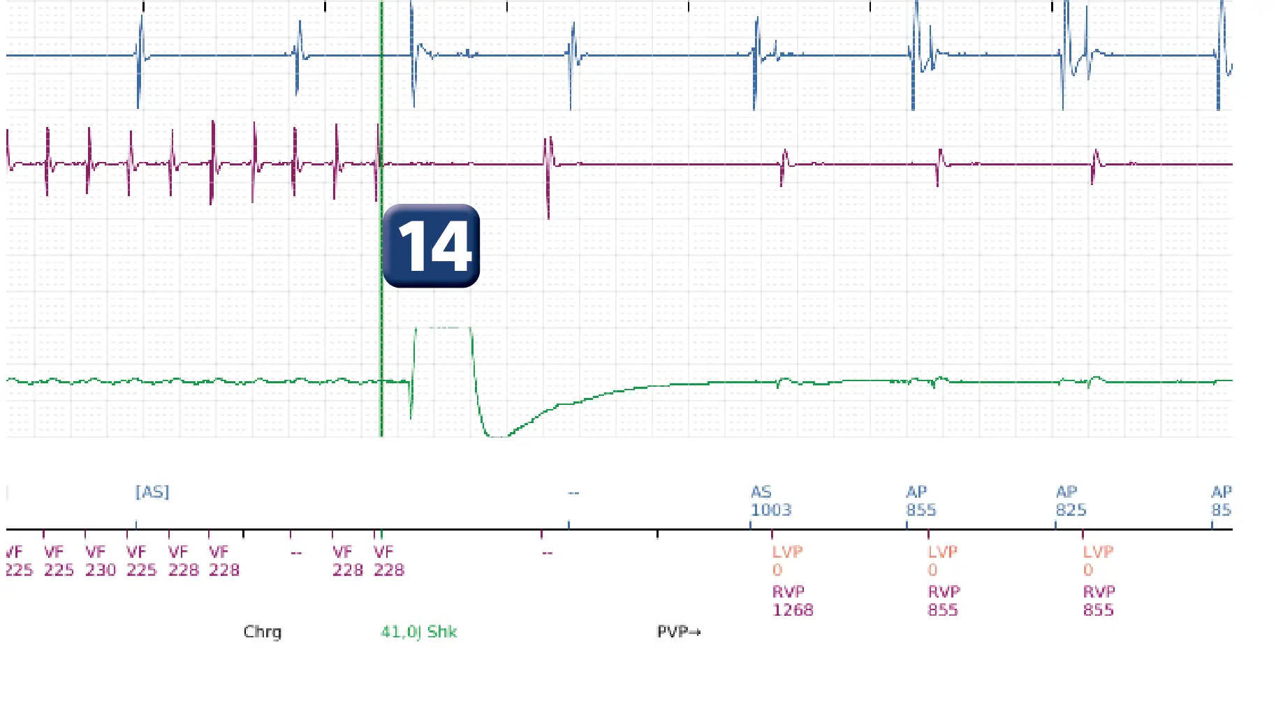 Électrogramme Boston Scientific DAI, segment 16 sur 16 — Choc à faible amplitude et accélération de l’arythmie
