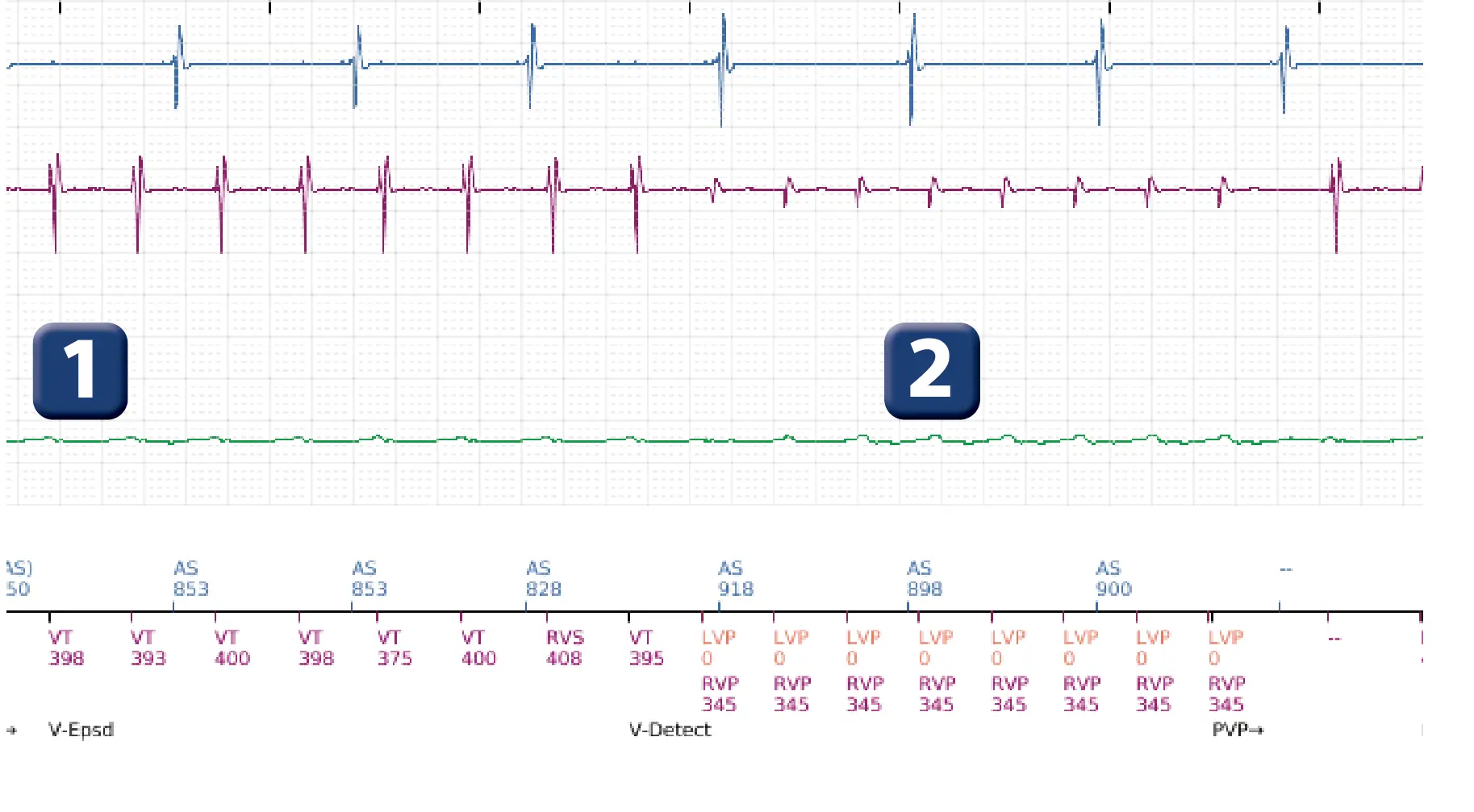 Électrogramme Boston Scientific DAI, segment 2 sur 16 — Choc à faible amplitude et accélération de l’arythmie