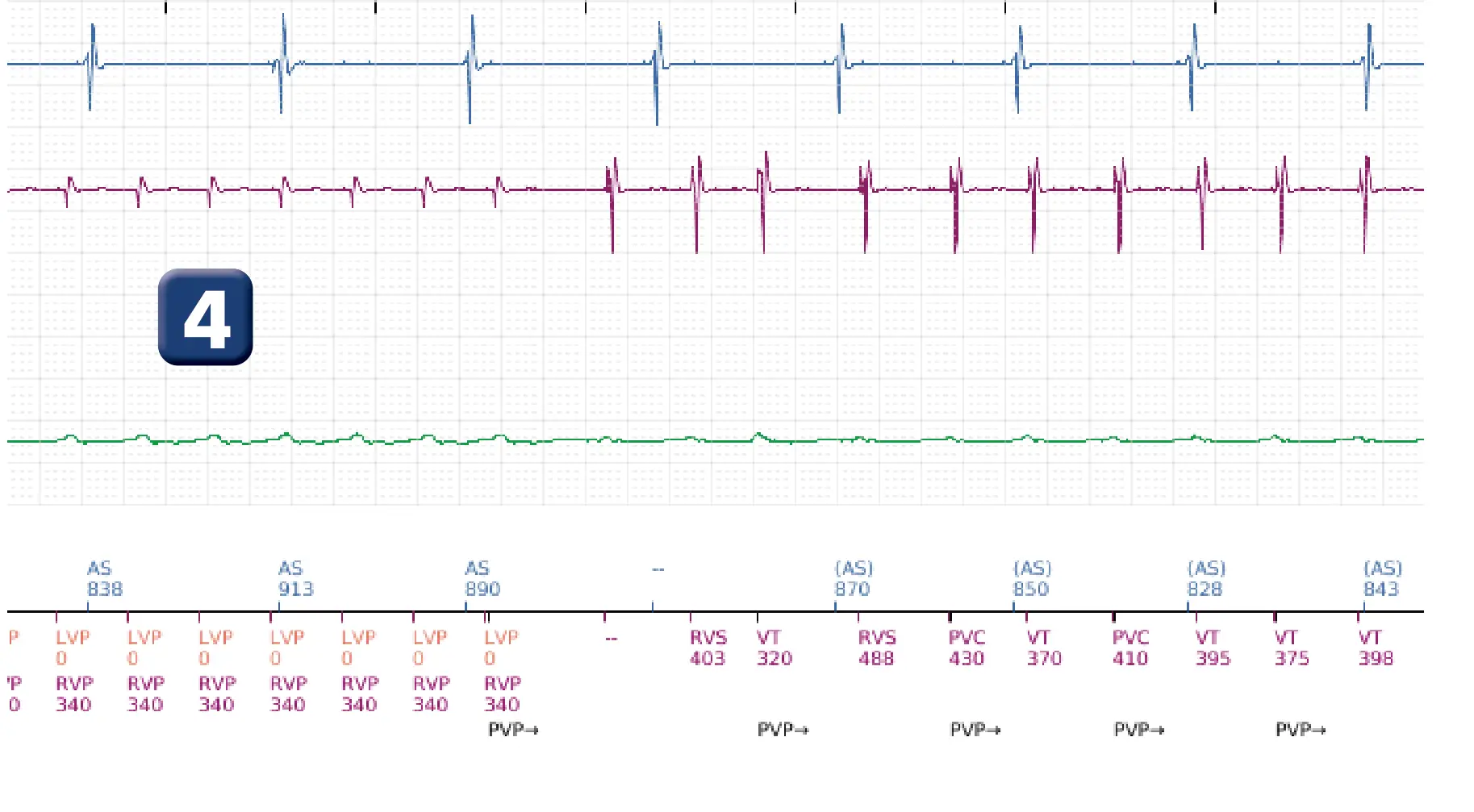 Électrogramme Boston Scientific DAI, segment 4 sur 16 — Choc à faible amplitude et accélération de l’arythmie