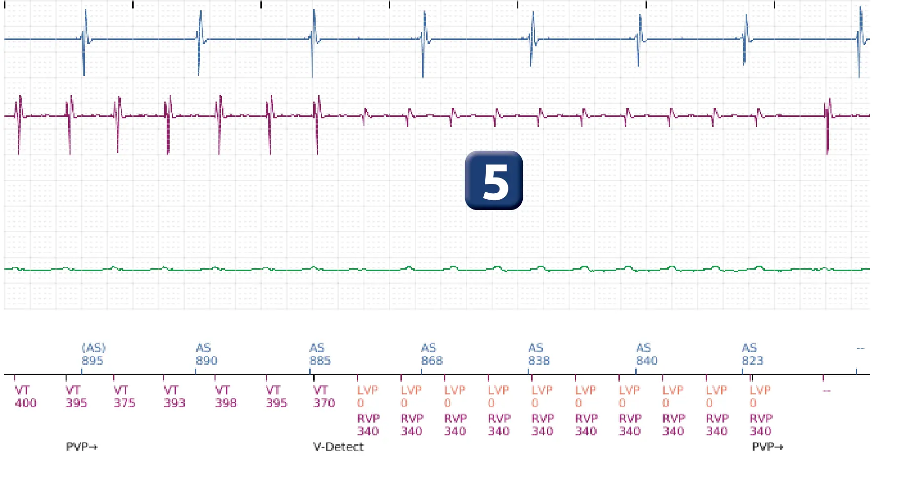 Électrogramme Boston Scientific DAI, segment 5 sur 16 — Choc à faible amplitude et accélération de l’arythmie