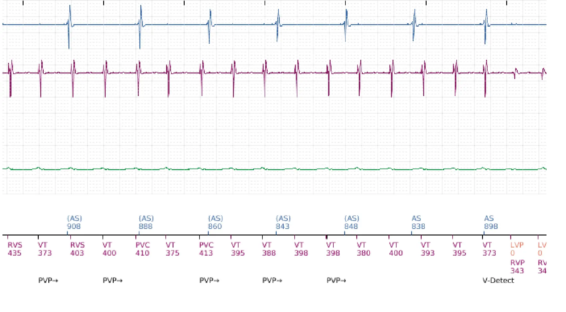 Électrogramme Boston Scientific DAI, segment 6 sur 16 — Choc à faible amplitude et accélération de l’arythmie
