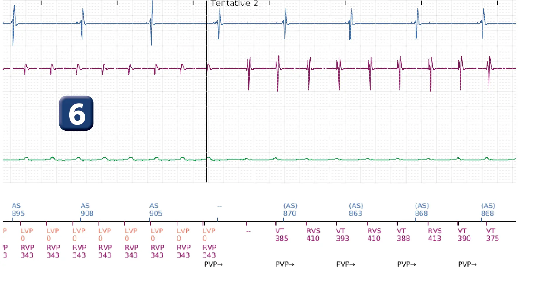 Électrogramme Boston Scientific DAI, segment 7 sur 16 — Choc à faible amplitude et accélération de l’arythmie