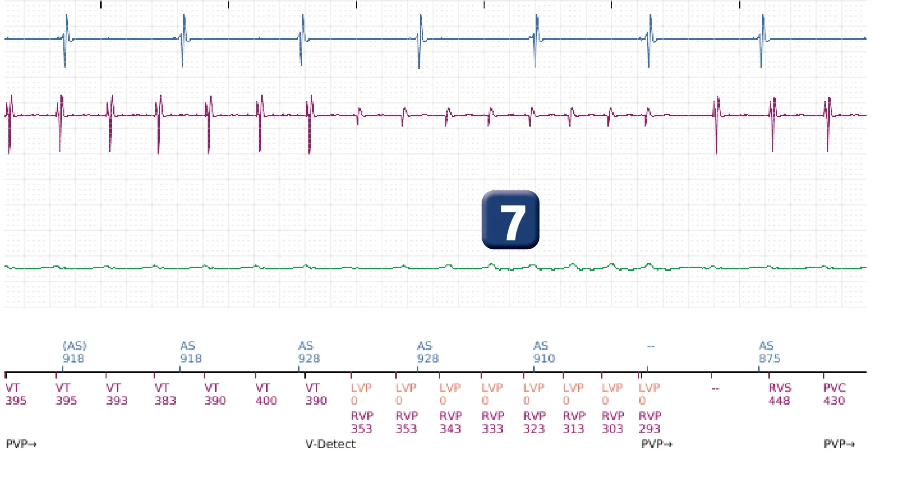 Électrogramme Boston Scientific DAI, segment 8 sur 16 — Choc à faible amplitude et accélération de l’arythmie