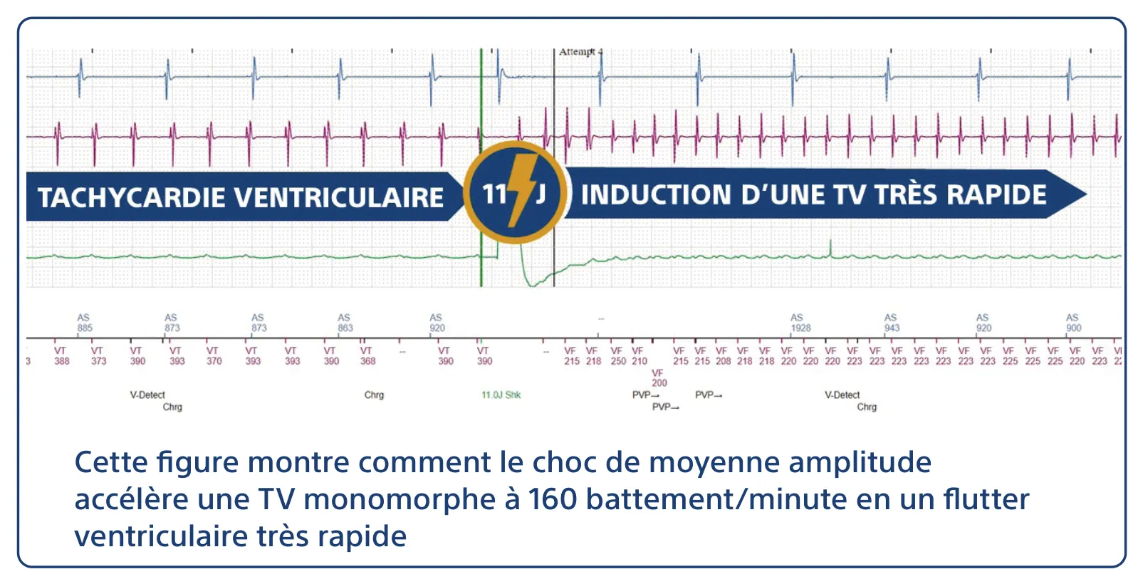 Cette figure montre comment le choc de moyenne amplitude accélère une TV monomorphe à 160 battement/minute en un flutter ventriculaire très rapide