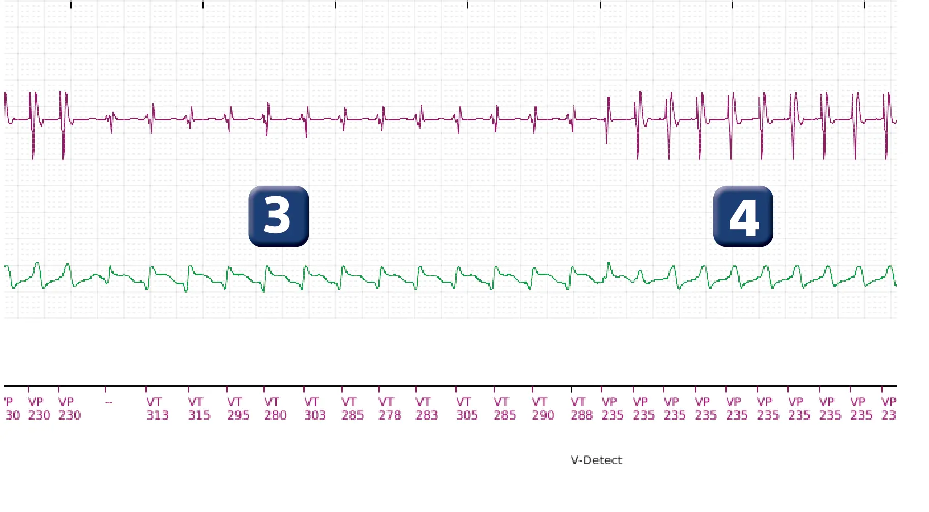 Électrogramme Boston Scientific DAI, segment 3 sur 10 — Choc maximal en zone de TV