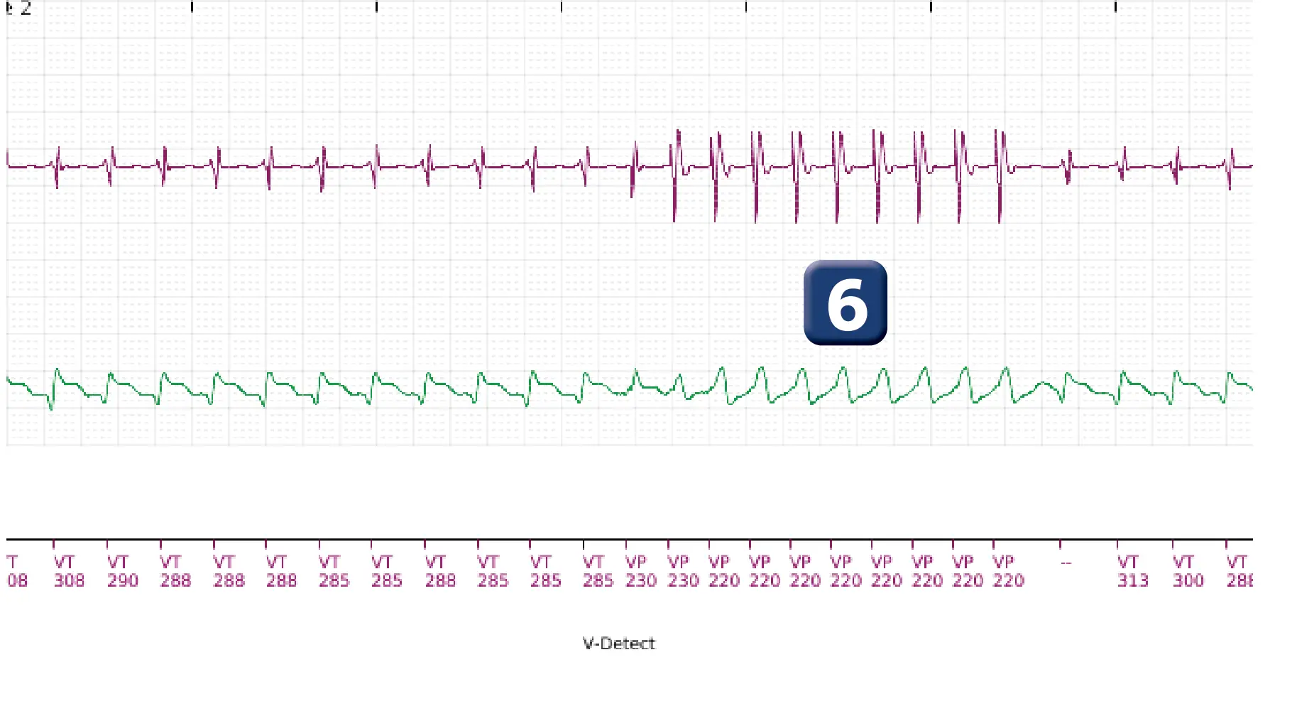 Électrogramme Boston Scientific DAI, segment 5 sur 10 — Choc maximal en zone de TV