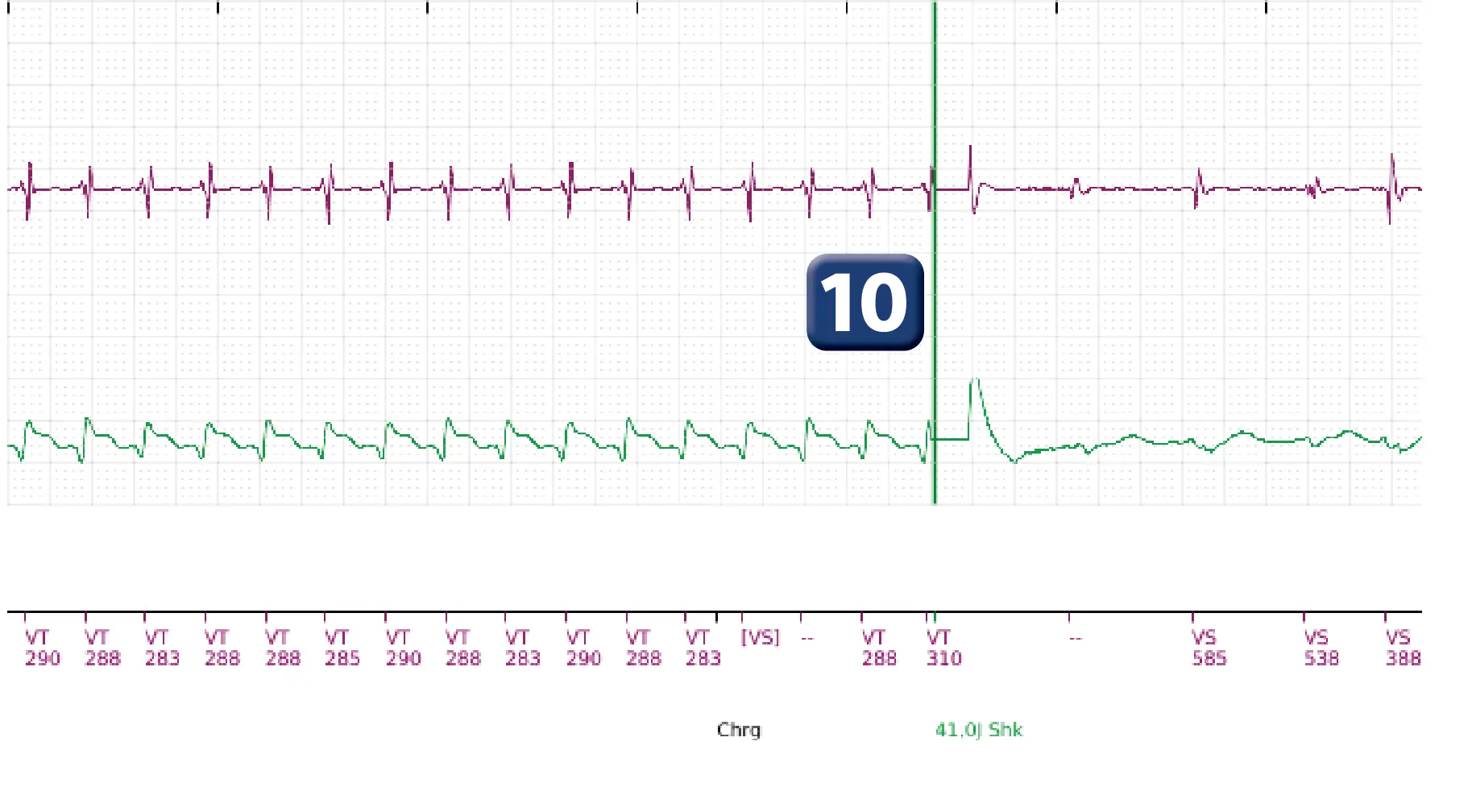 Électrogramme Boston Scientific DAI, segment 9 sur 10 — Choc maximal en zone de TV