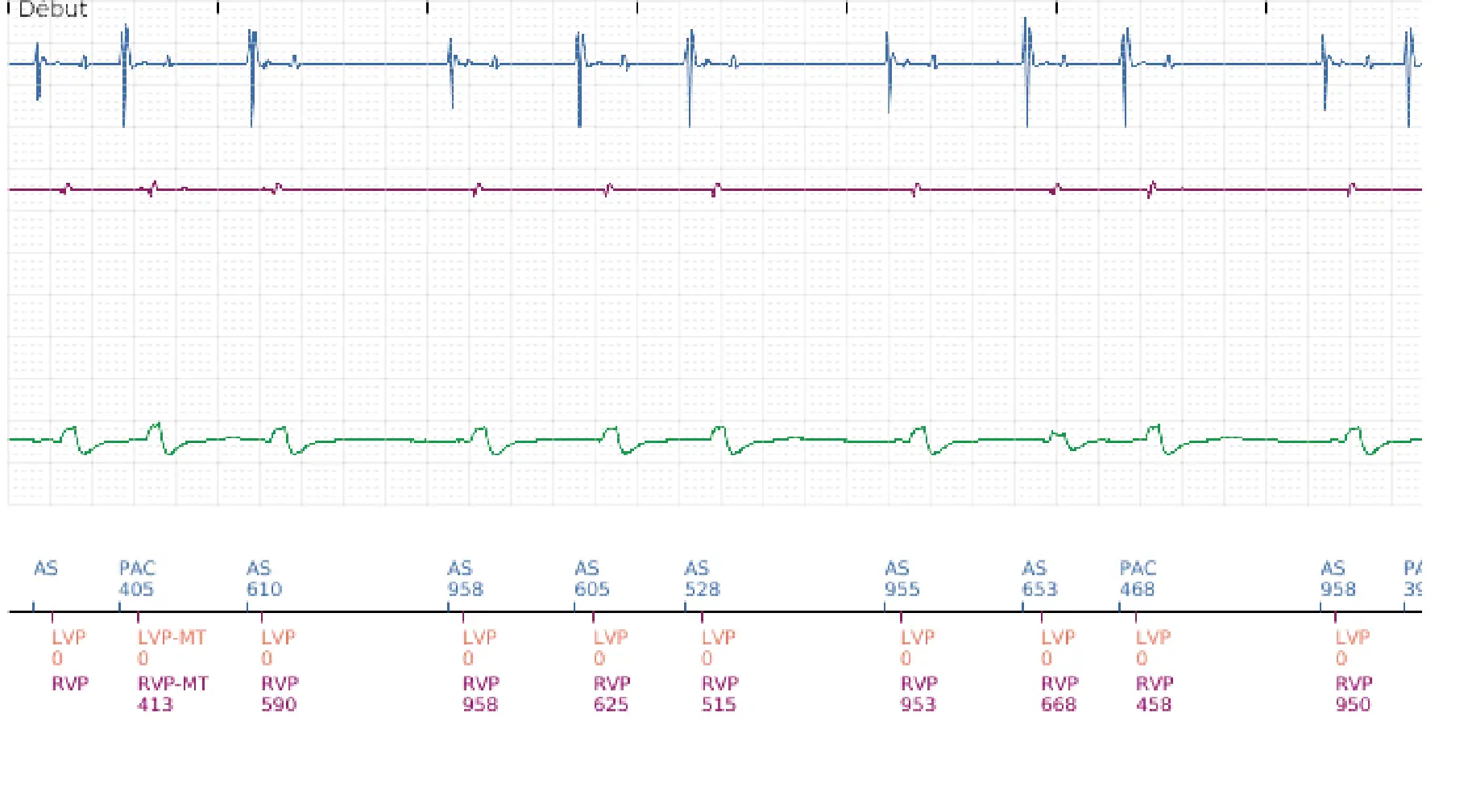 Électrogramme Boston Scientific DAI, segment 1 sur 6 — Stimulation anti-tachycardique en zone de TV et accélération en zone de FV
