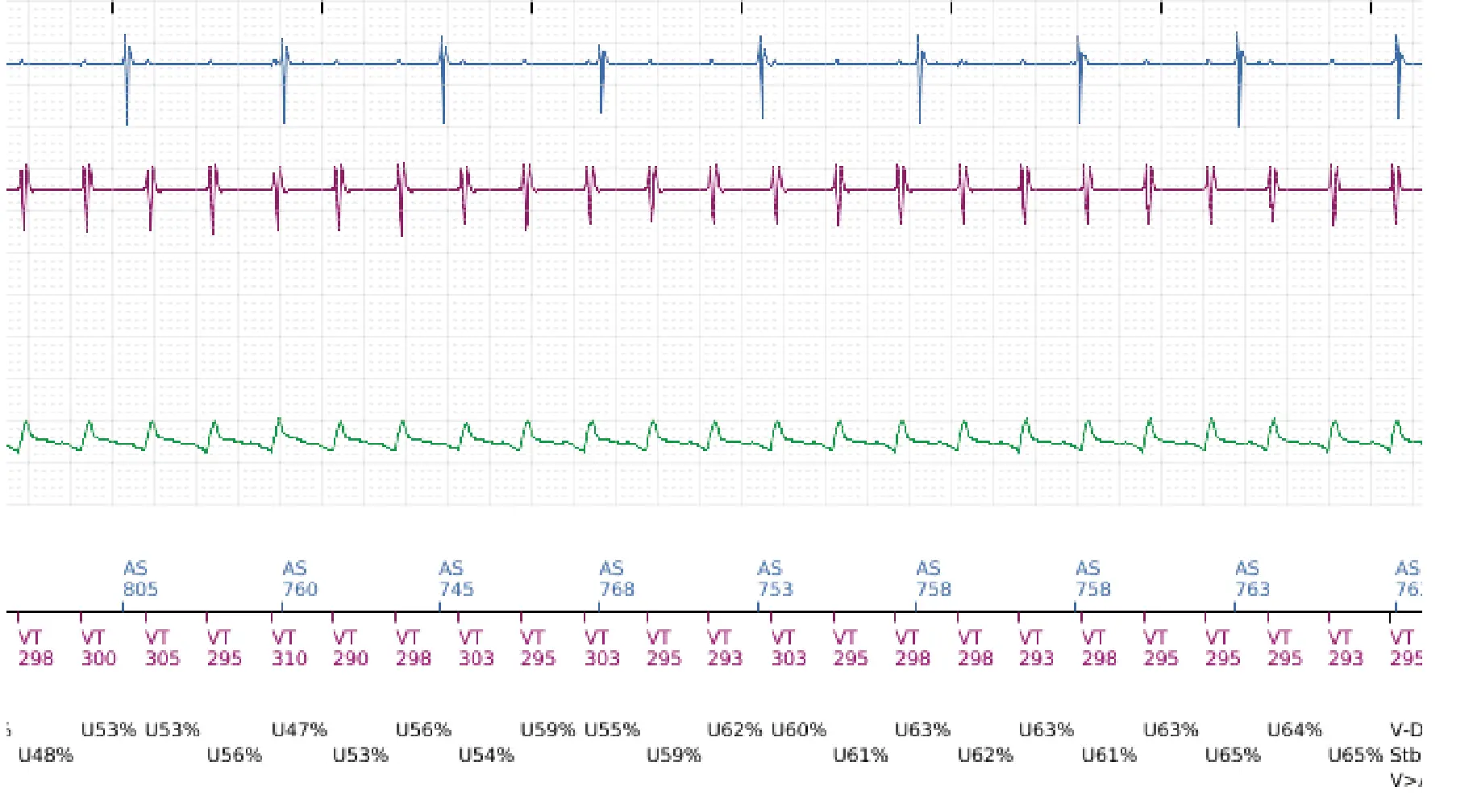Électrogramme Boston Scientific DAI, segment 3 sur 6 — Stimulation anti-tachycardique en zone de TV et accélération en zone de FV