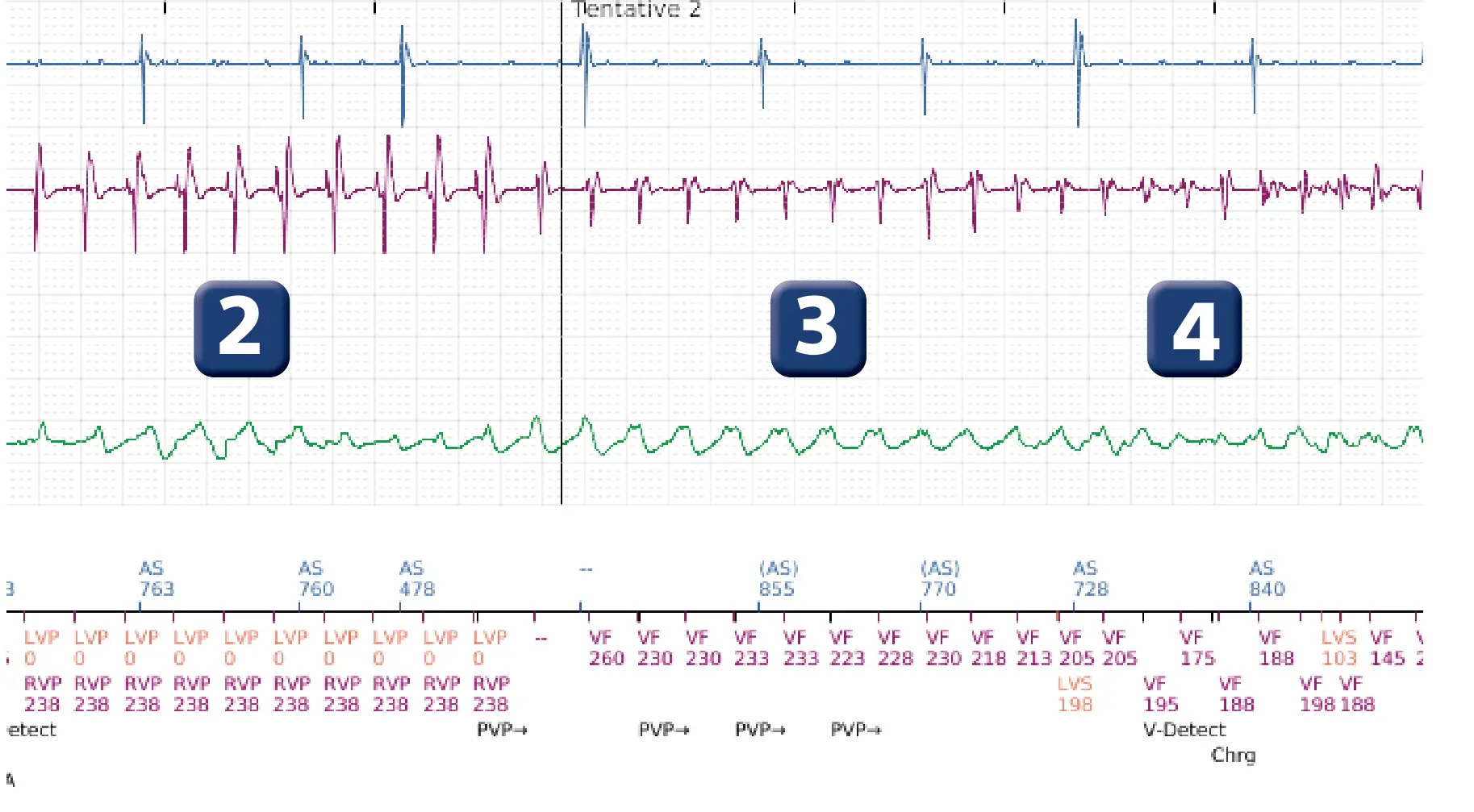 Électrogramme Boston Scientific DAI, segment 4 sur 6 — Stimulation anti-tachycardique en zone de TV et accélération en zone de FV