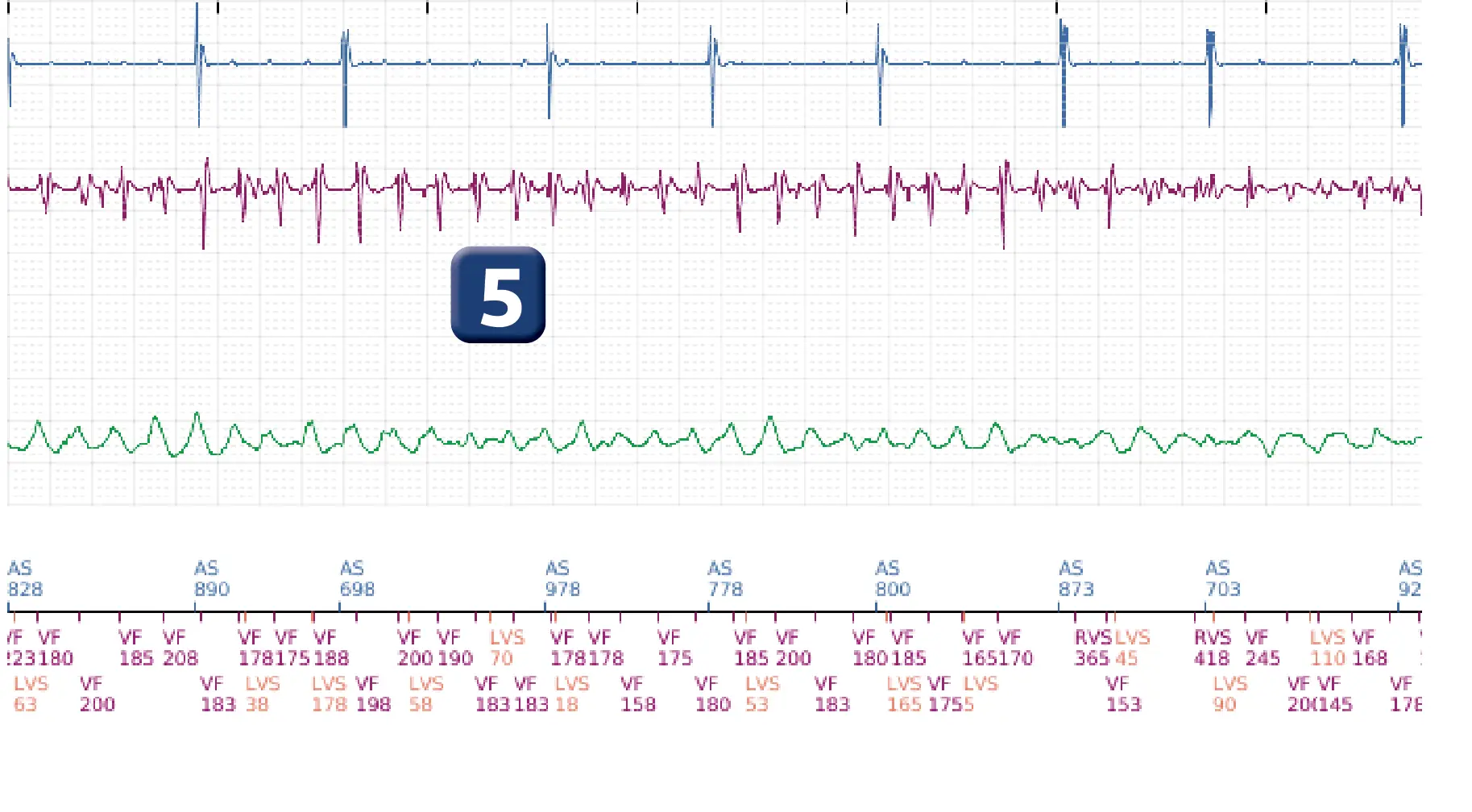 Électrogramme Boston Scientific DAI, segment 5 sur 6 — Stimulation anti-tachycardique en zone de TV et accélération en zone de FV