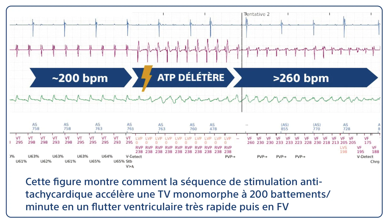 Cette figure montre comment la séquence de stimulation anti-tachycardique accélère une TV monomorphe à 200 battements/minute en un flutter ventriculaire très rapide puis en FV