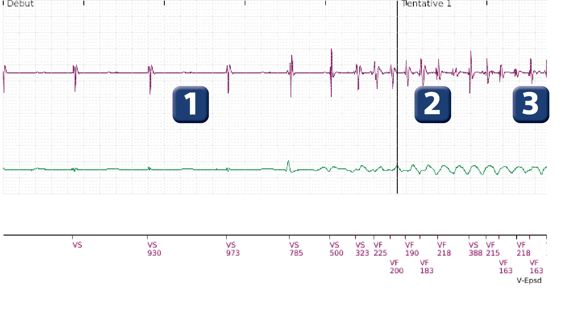 Électrogramme Boston Scientific DAI, segment 1 sur 3 — Episode de FV avec choc de petite amplitude chez un enfant