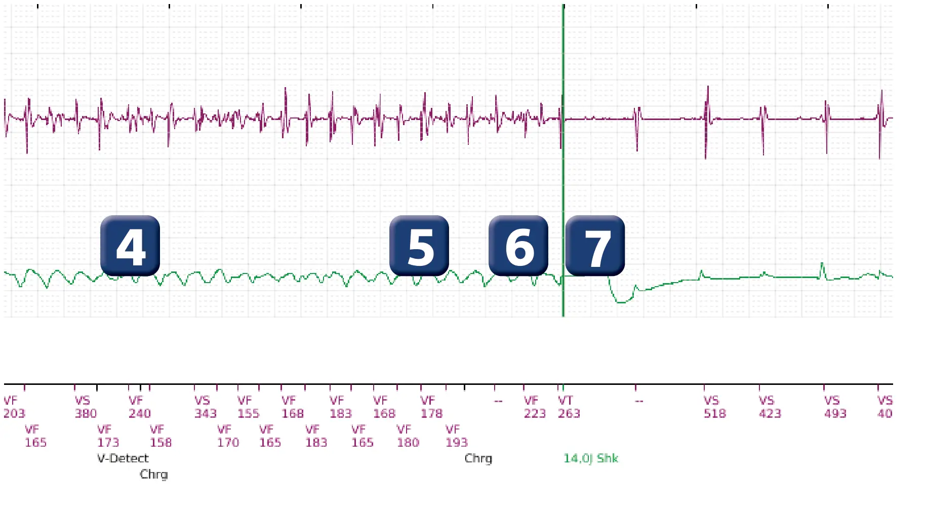 Électrogramme Boston Scientific DAI, segment 2 sur 3 — Episode de FV avec choc de petite amplitude chez un enfant