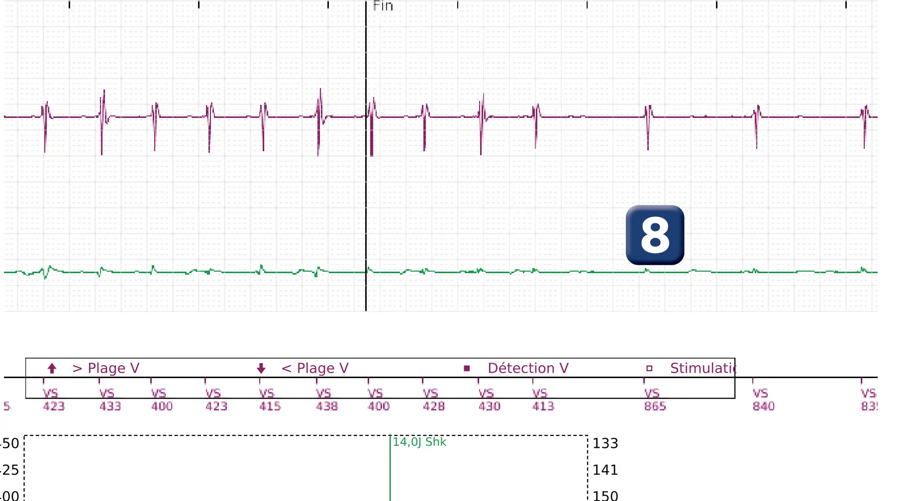 Électrogramme Boston Scientific DAI, segment 3 sur 3 — Episode de FV avec choc de petite amplitude chez un enfant