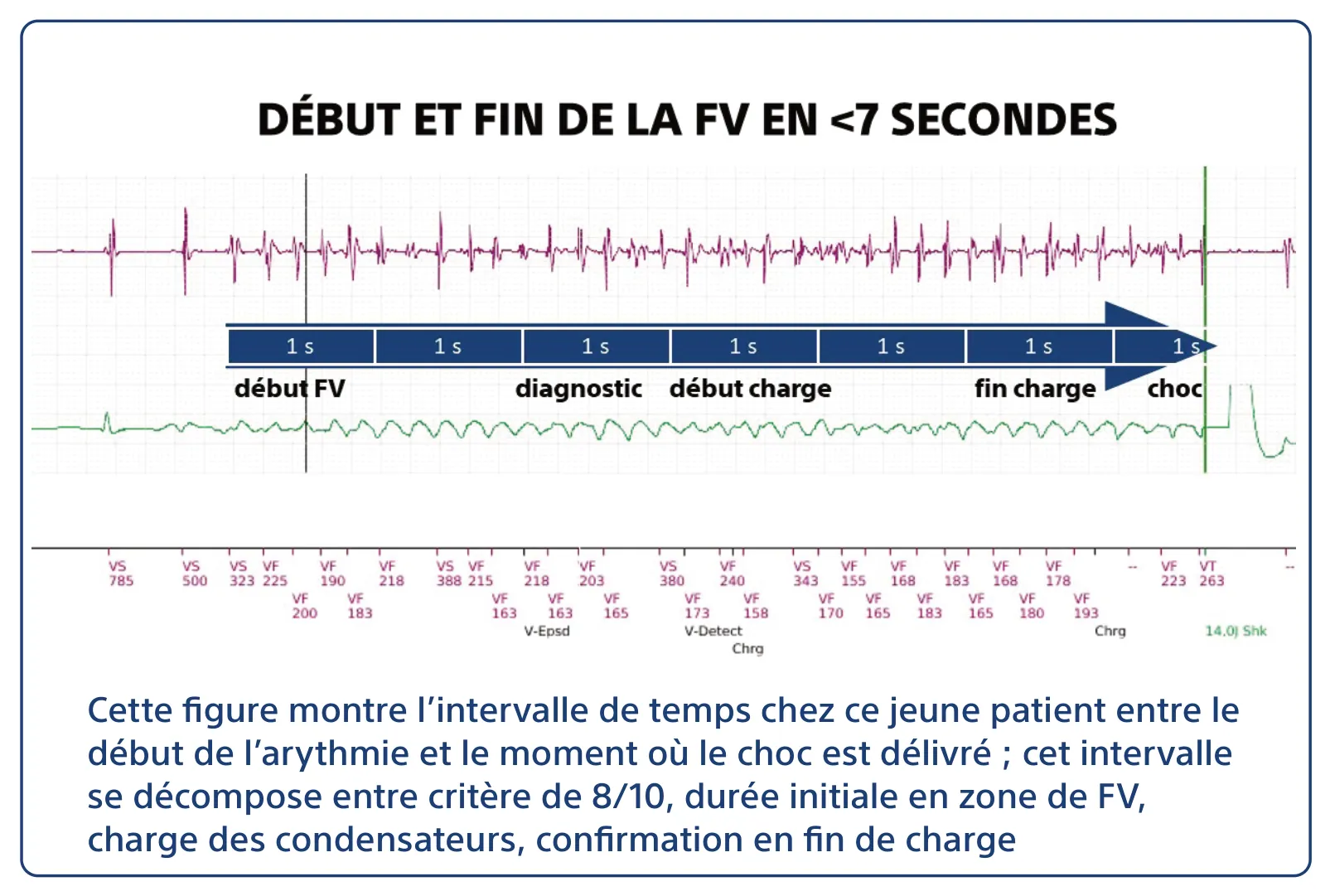 Cette figure montre l’intervalle de temps chez ce jeune patient entre le début de l’arythmie et le moment où le choc est délivré ; cet intervalle se décompose entre critère de 8/10, durée initiale en zone de FV, charge des condensateurs, confirmation en fin de charge