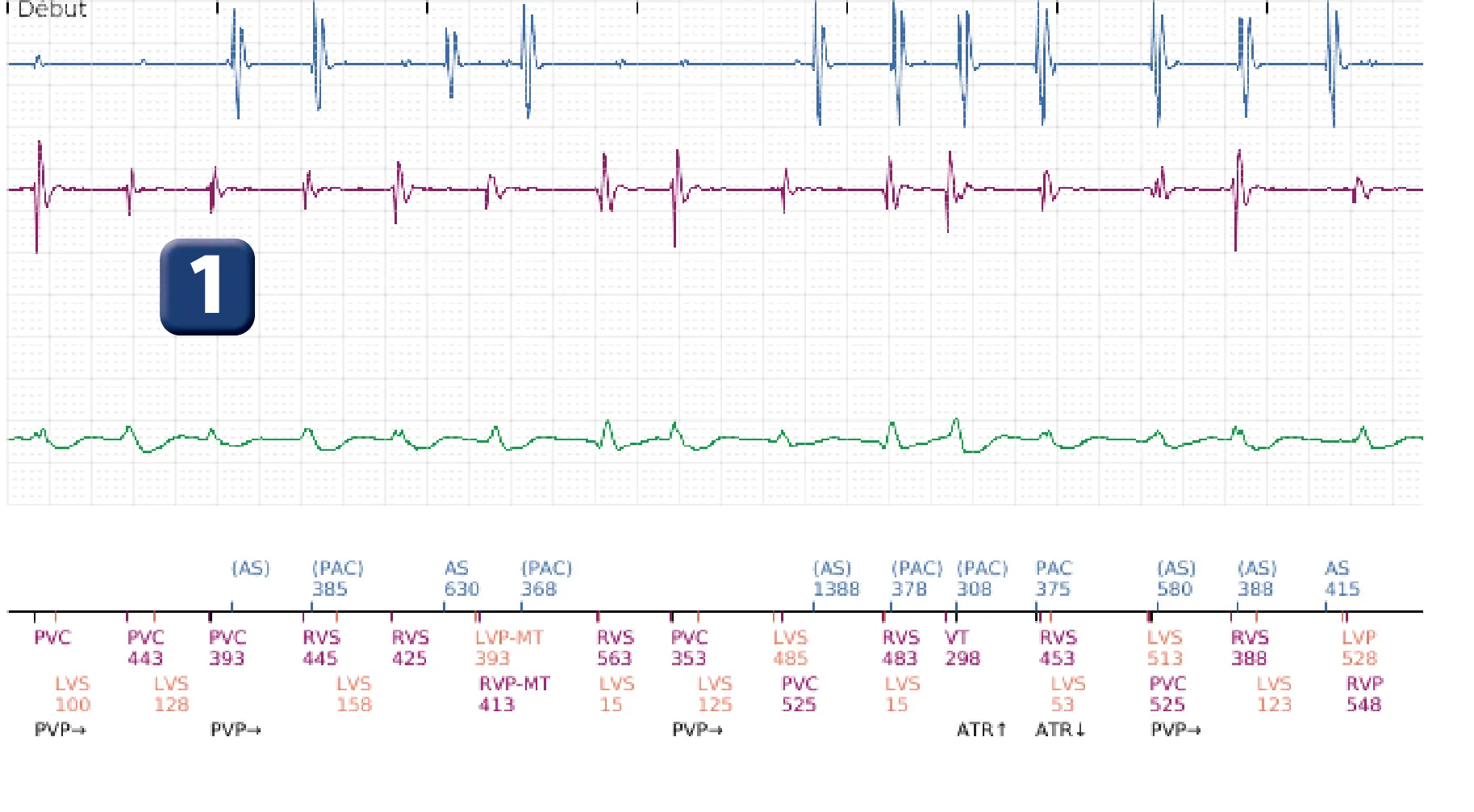 Électrogramme Boston Scientific DAI, segment 1 sur 12 — Série de chocs électriques en zone de FV