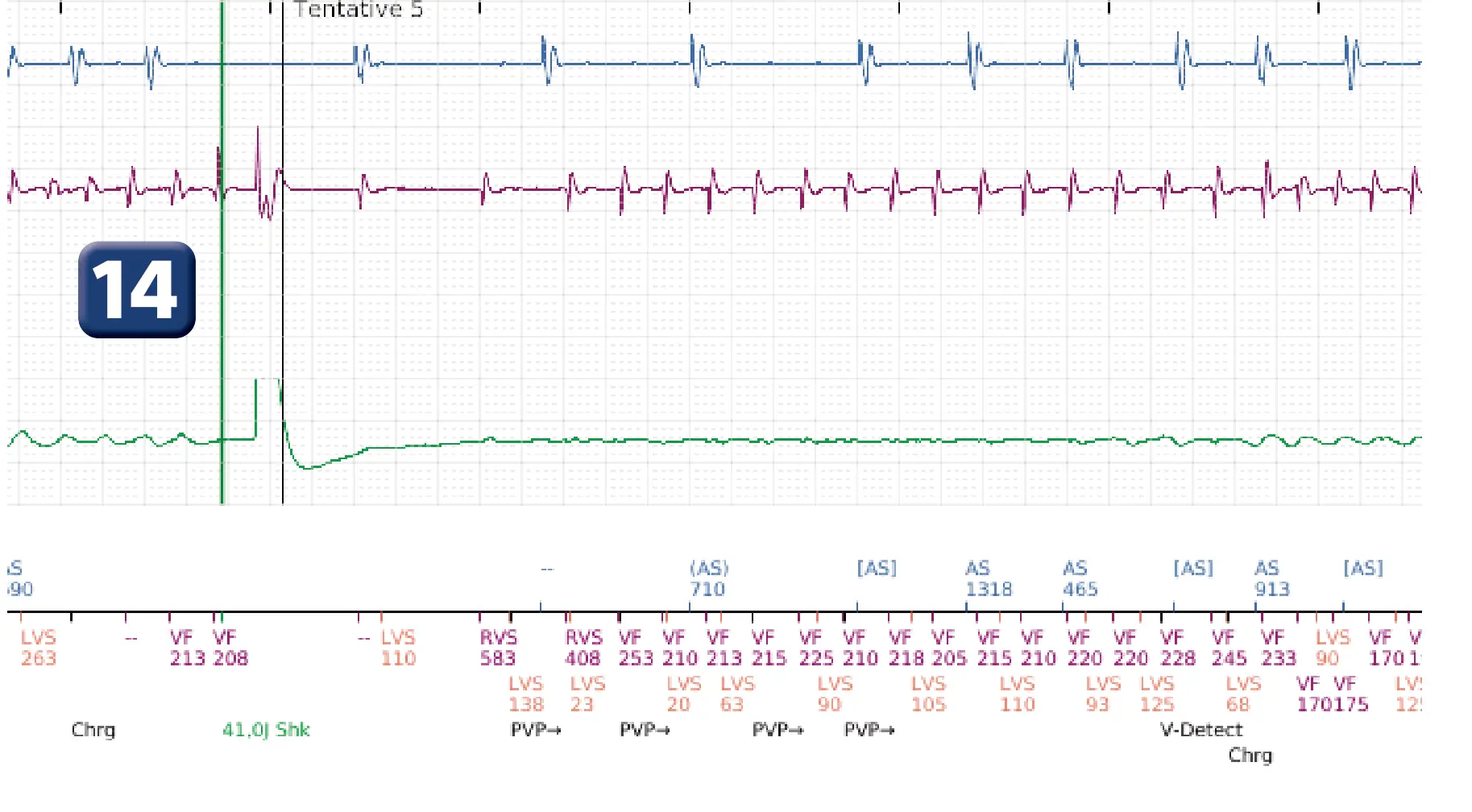 Électrogramme Boston Scientific DAI, segment 10 sur 12 — Série de chocs électriques en zone de FV