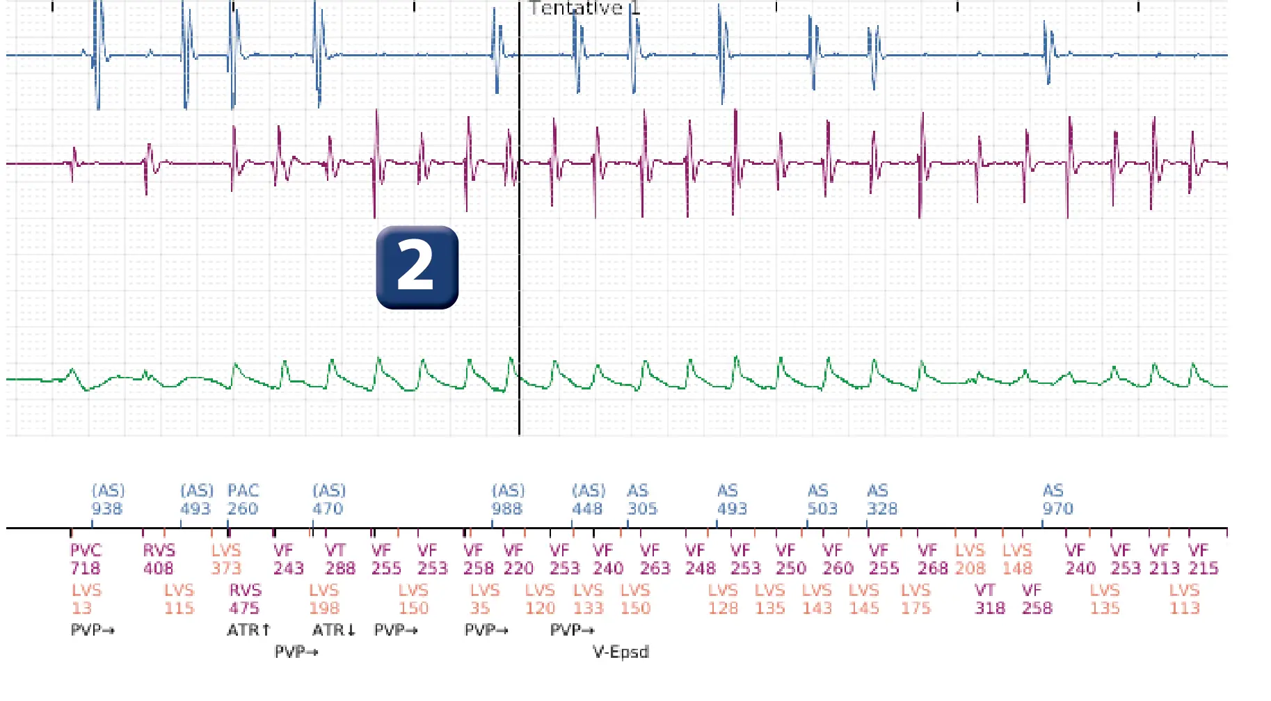 Électrogramme Boston Scientific DAI, segment 2 sur 12 — Série de chocs électriques en zone de FV