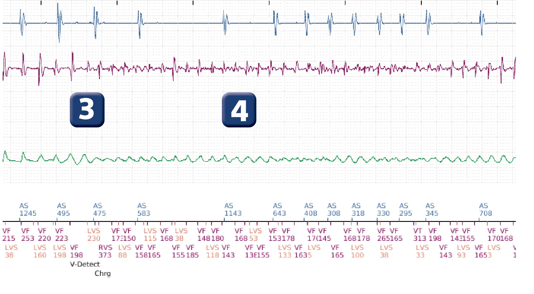 Électrogramme Boston Scientific DAI, segment 3 sur 12 — Série de chocs électriques en zone de FV