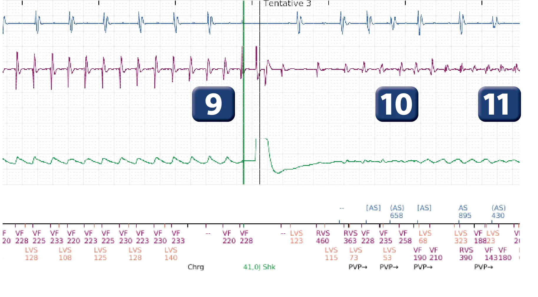 Électrogramme Boston Scientific DAI, segment 6 sur 12 — Série de chocs électriques en zone de FV