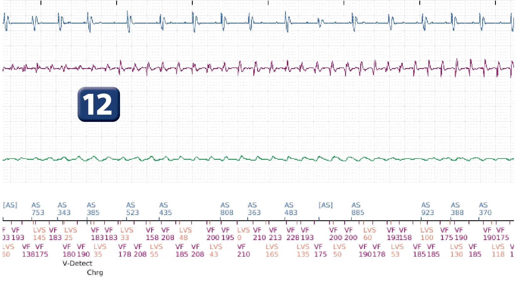 Électrogramme Boston Scientific DAI, segment 7 sur 12 — Série de chocs électriques en zone de FV