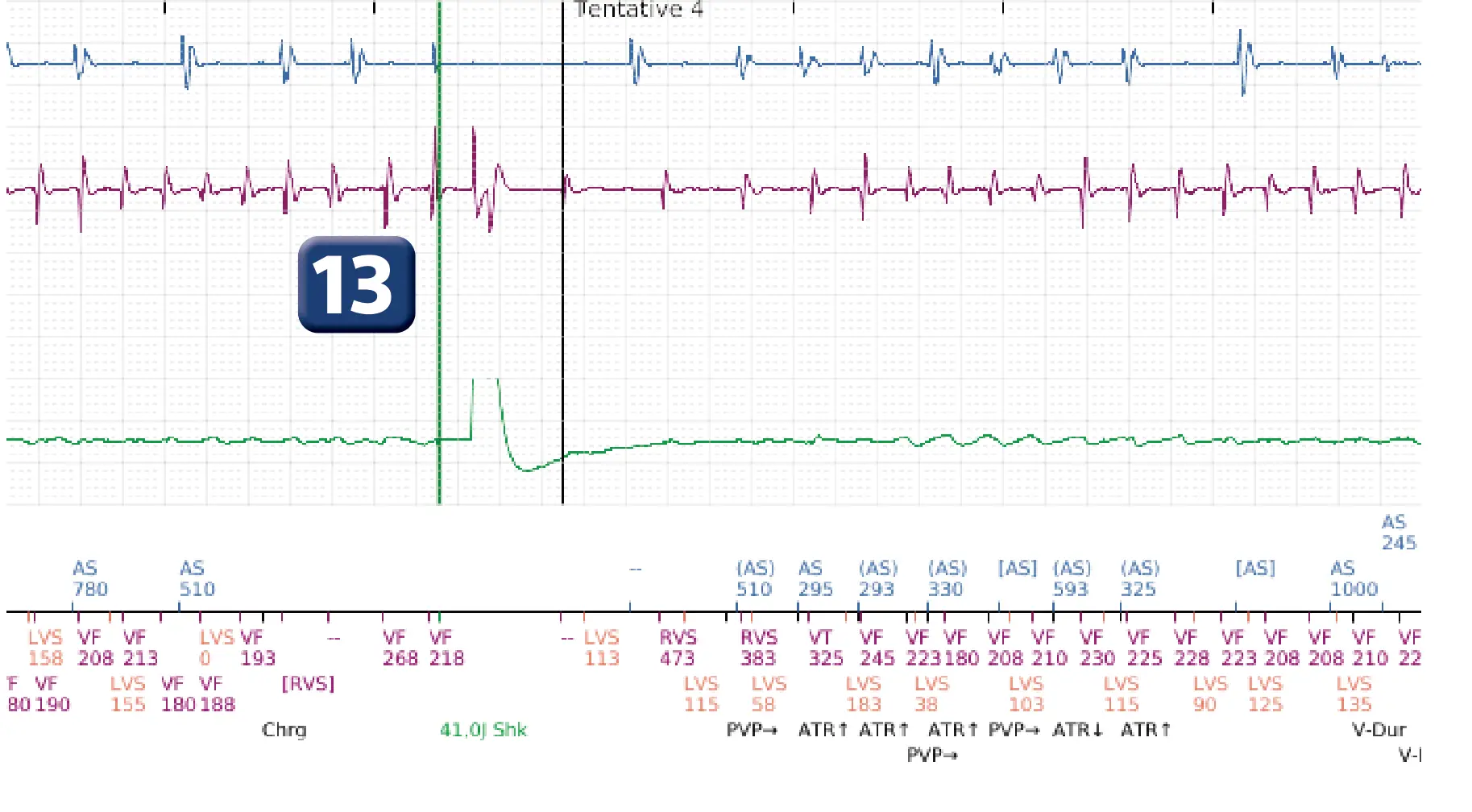Électrogramme Boston Scientific DAI, segment 8 sur 12 — Série de chocs électriques en zone de FV