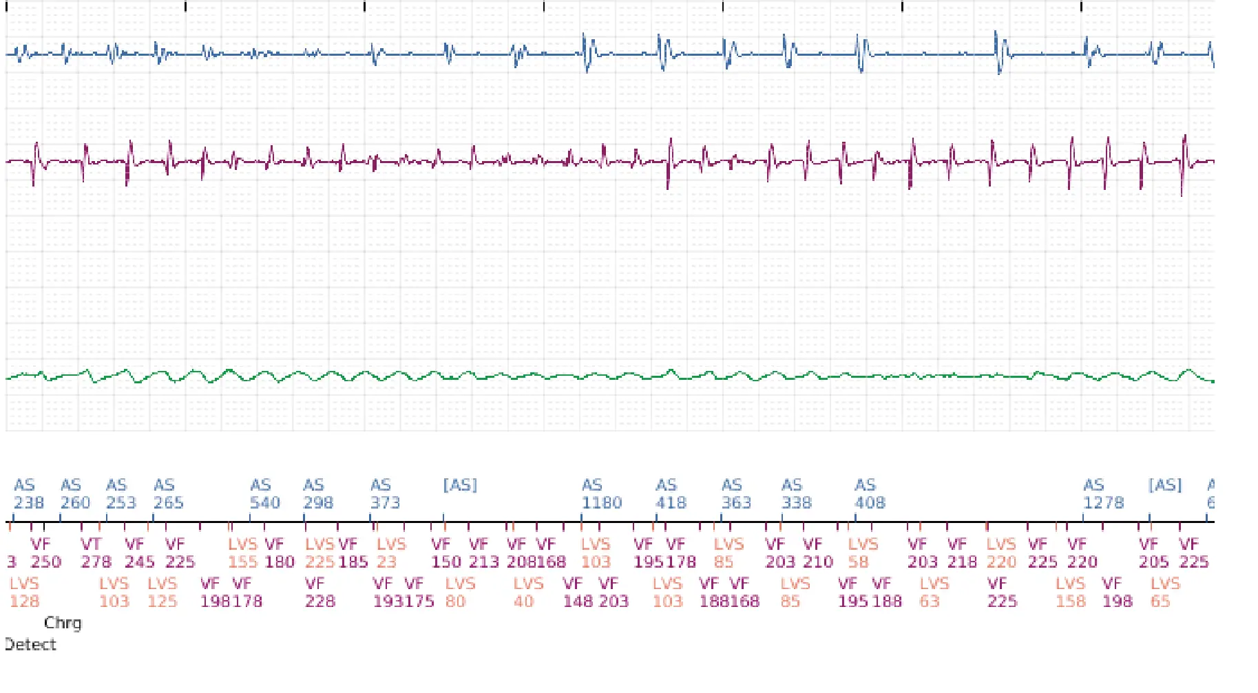 Électrogramme Boston Scientific DAI, segment 9 sur 12 — Série de chocs électriques en zone de FV