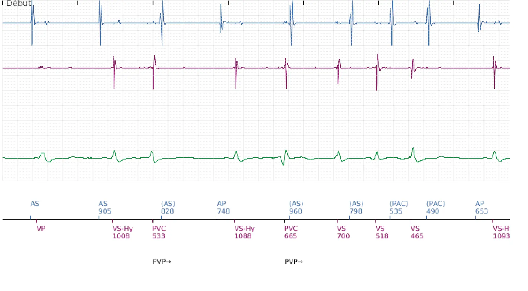 Électrogramme Boston Scientific DAI, segment 1 sur 14 — TV en zone de FV et seuil de défibrillation élevé