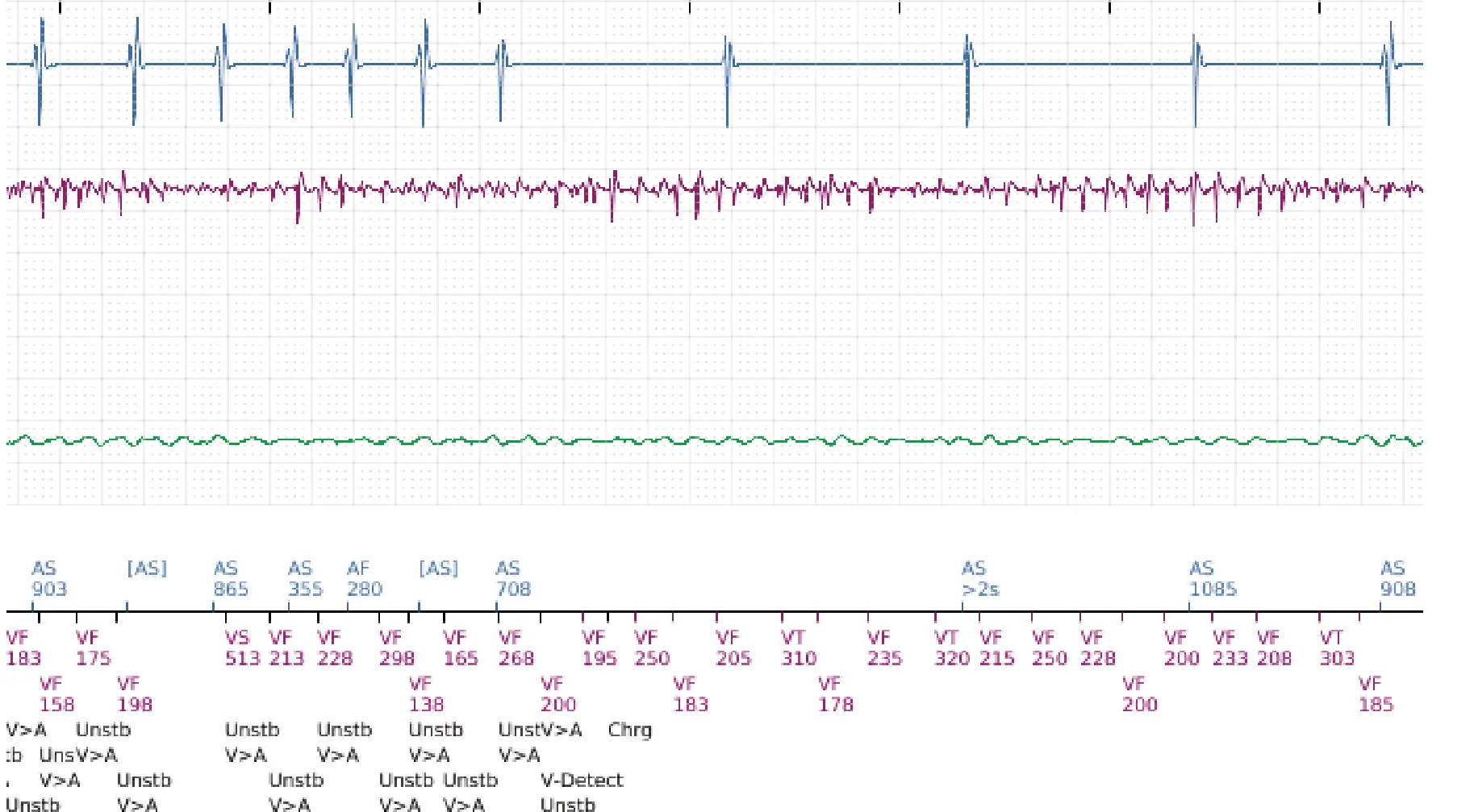 Électrogramme Boston Scientific DAI, segment 10 sur 14 — TV en zone de FV et seuil de défibrillation élevé